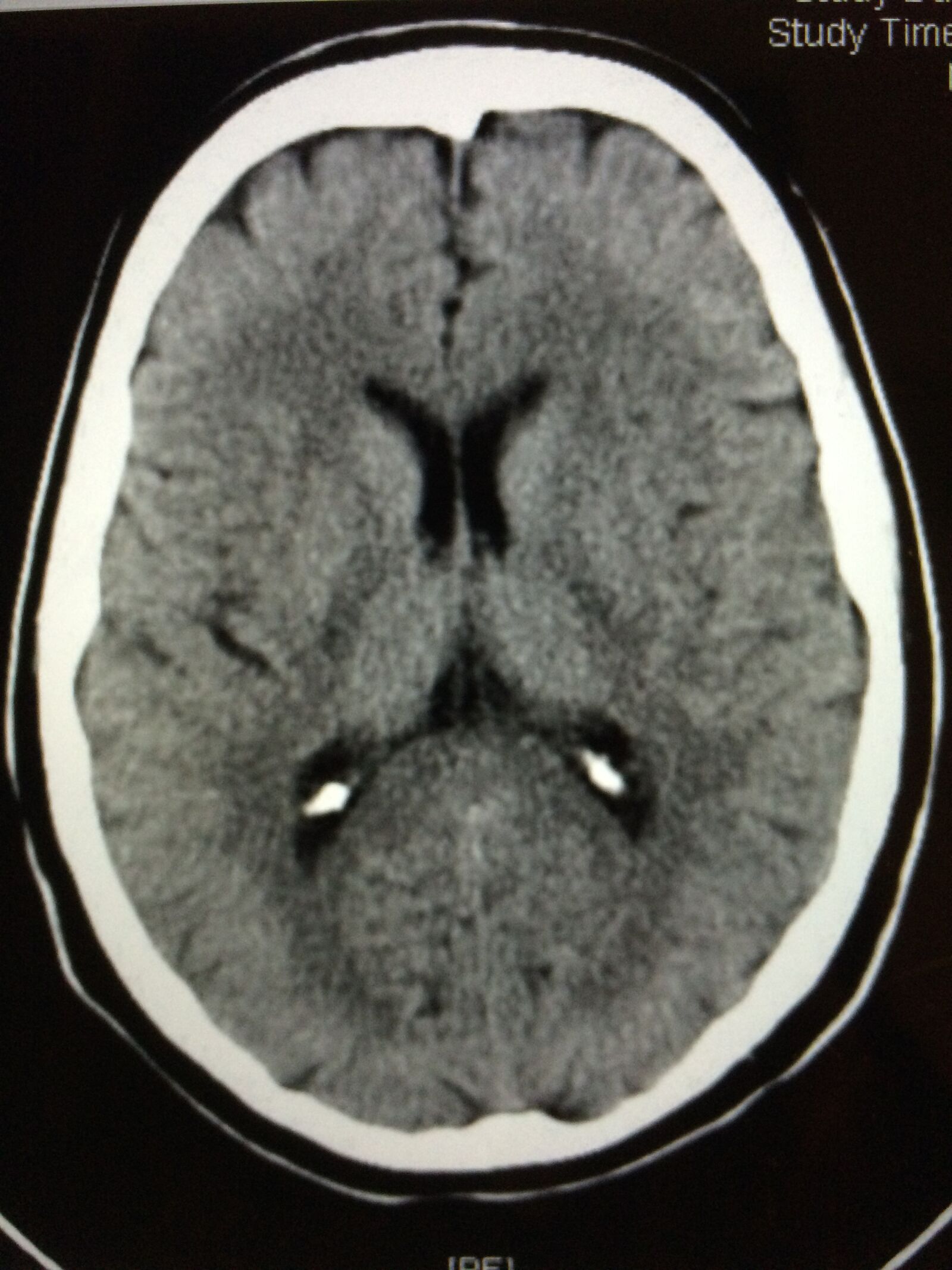 iPhone 5s back camera 4.15mm f/2.2 sample photo. Brain, ct scan, normal photography