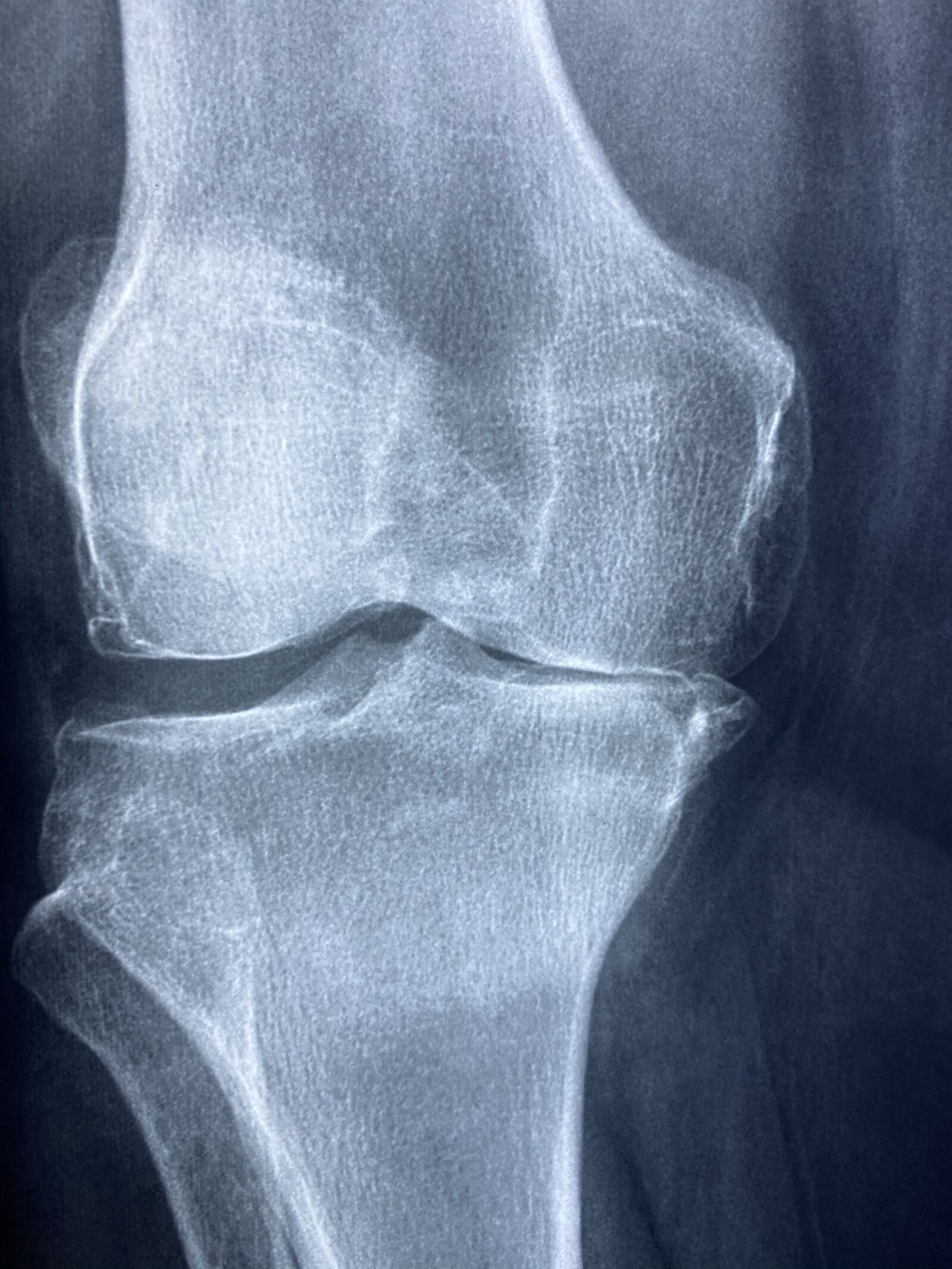 Apple iPhone 11 sample photo. Knee, x rays, arthritis photography