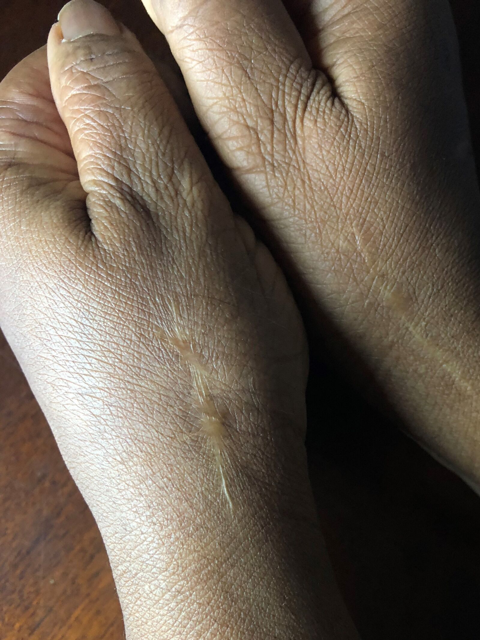 iPhone X back dual camera 4mm f/1.8 sample photo. Hand, arthritis, osteoporosis photography