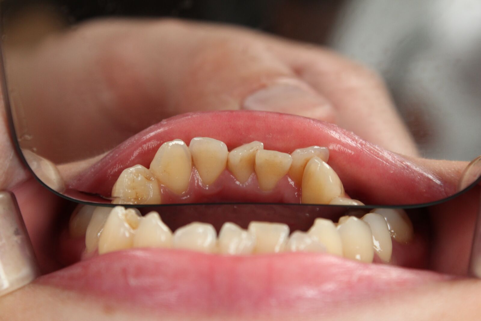 Canon EOS 600D (Rebel EOS T3i / EOS Kiss X5) sample photo. Tooth, dentist, mouth photography