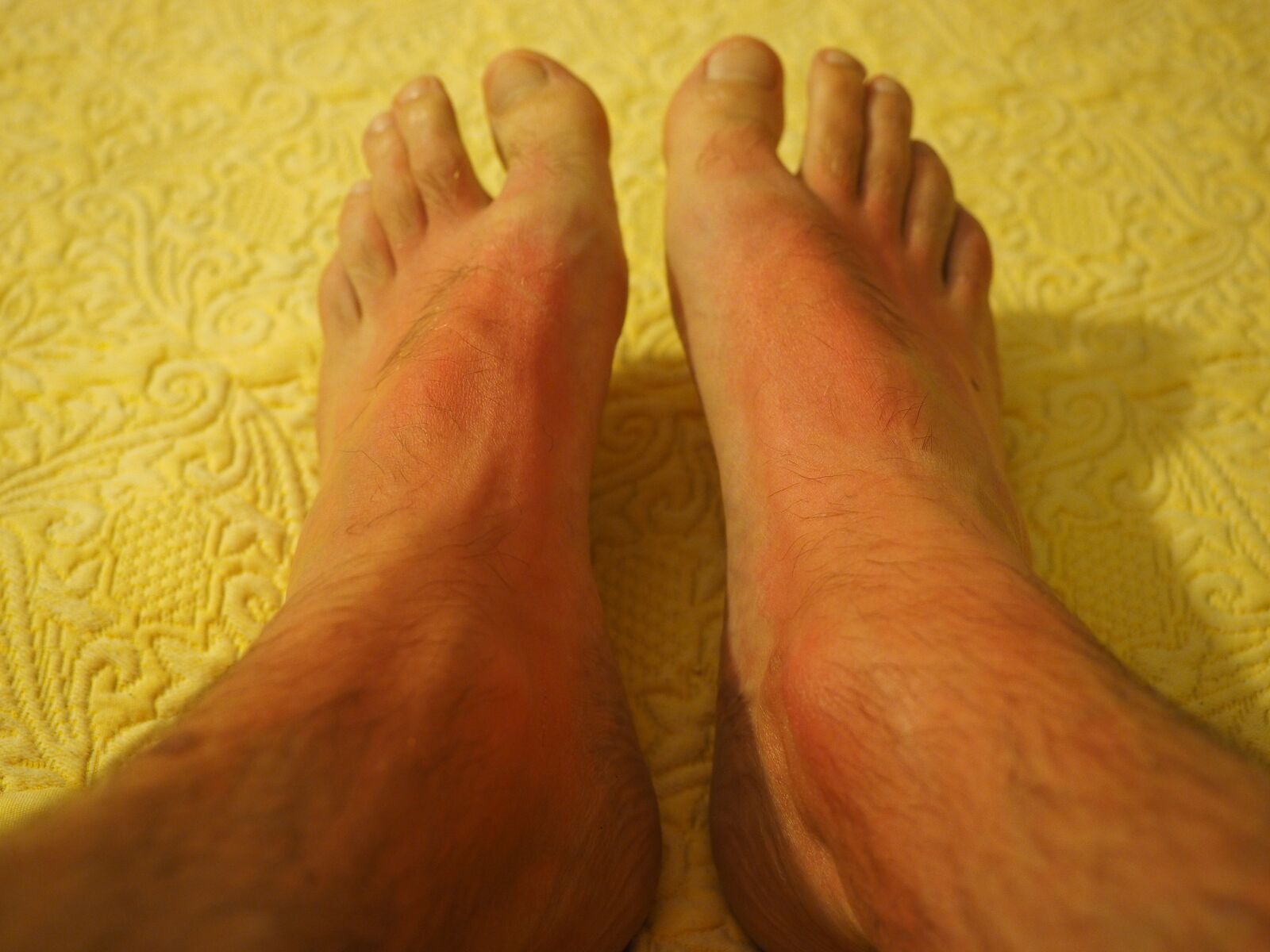 Olympus OM-D E-M1 + Olympus M.Zuiko Digital ED 12-40mm F2.8 Pro sample photo. Sunburn, feet, skin photography