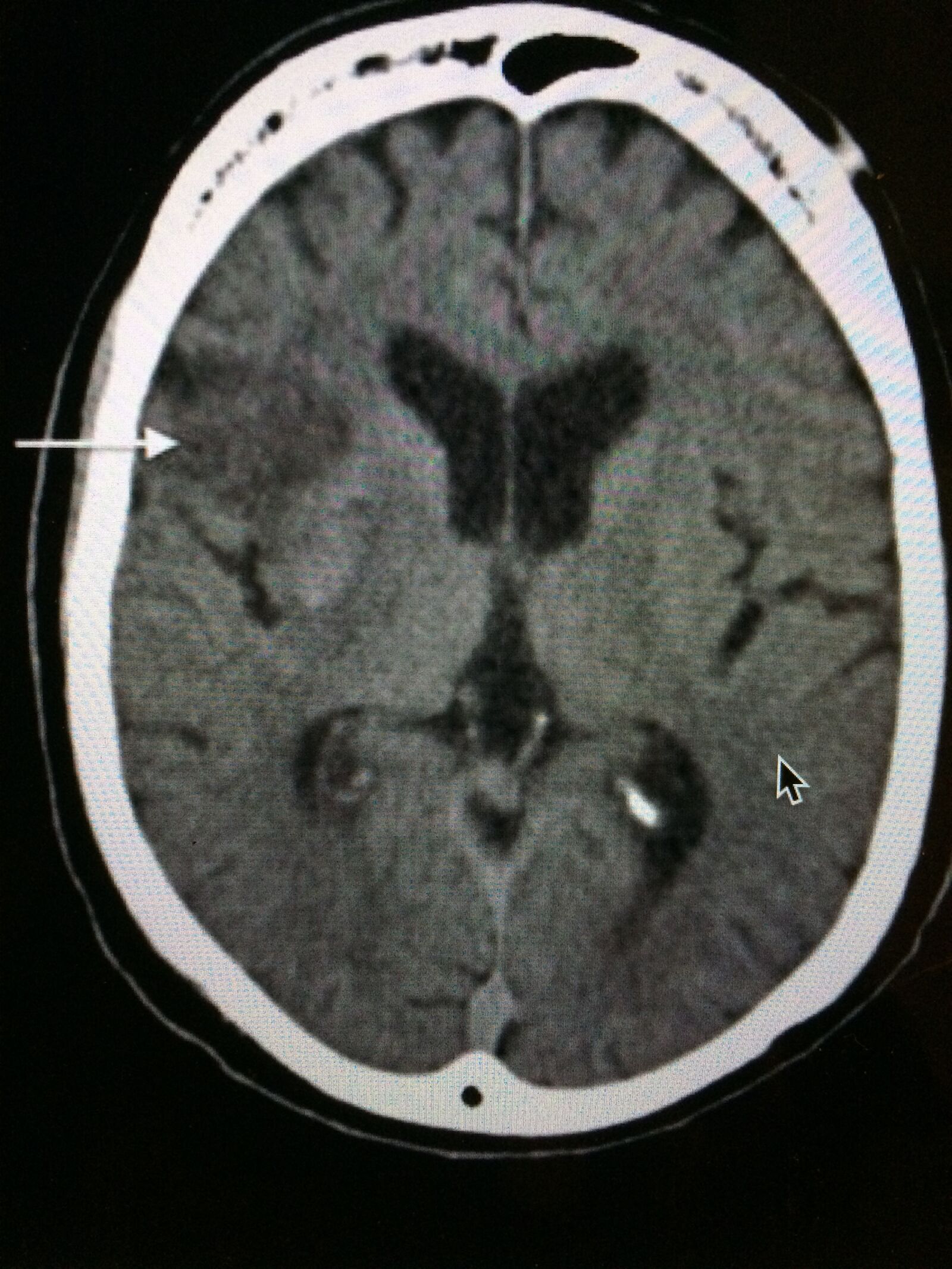 iPhone 5s back camera 4.15mm f/2.2 sample photo. Brain, ct scan, stroke photography