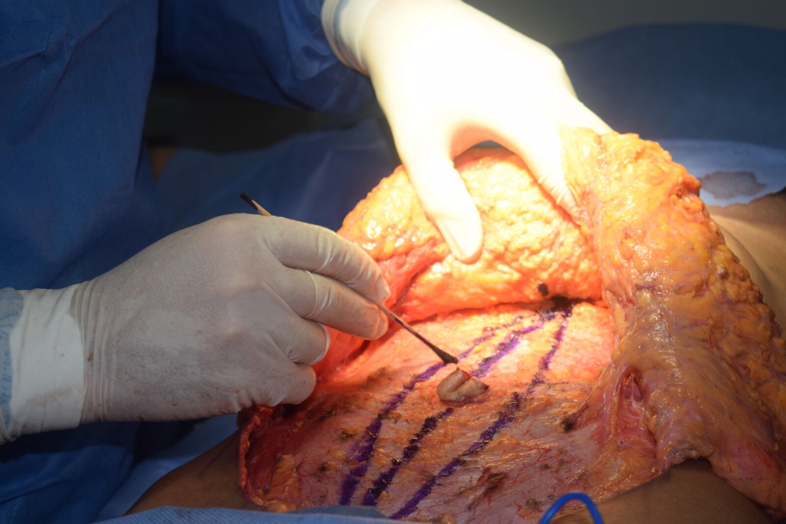 Nikon D3300 sample photo. Tummy tuck, dermolipectomy, plastic photography