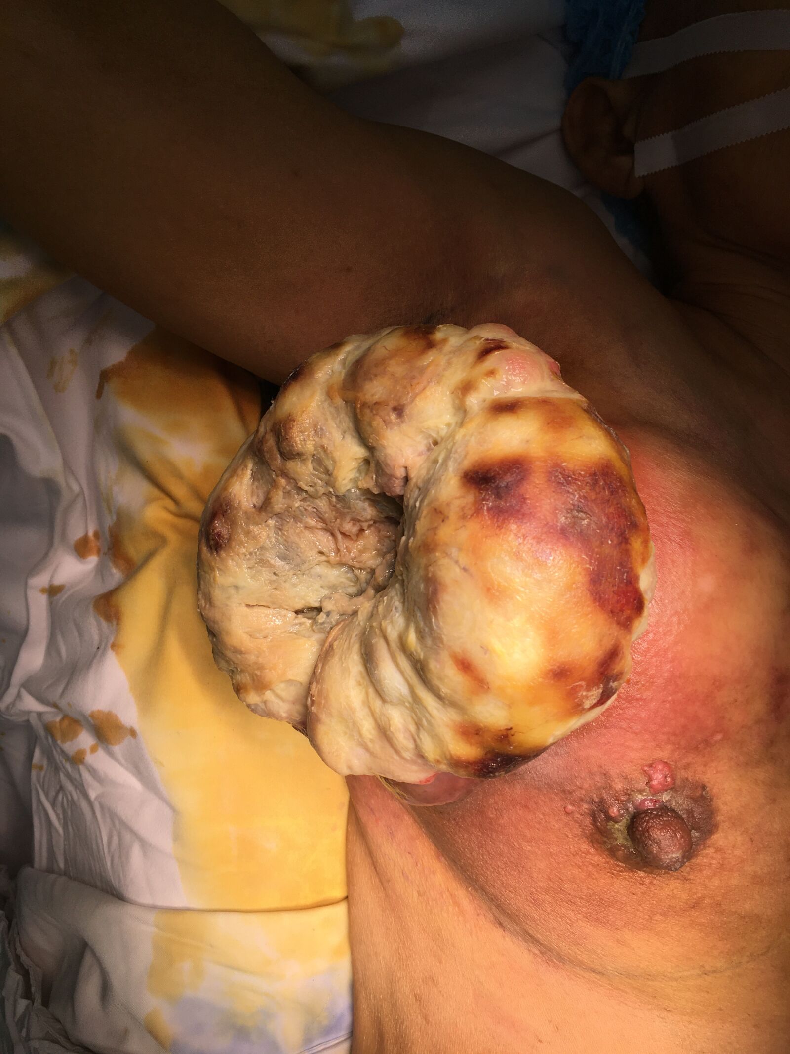 iPhone 6s back camera 4.15mm f/2.2 sample photo. Breast cancer, to go photography