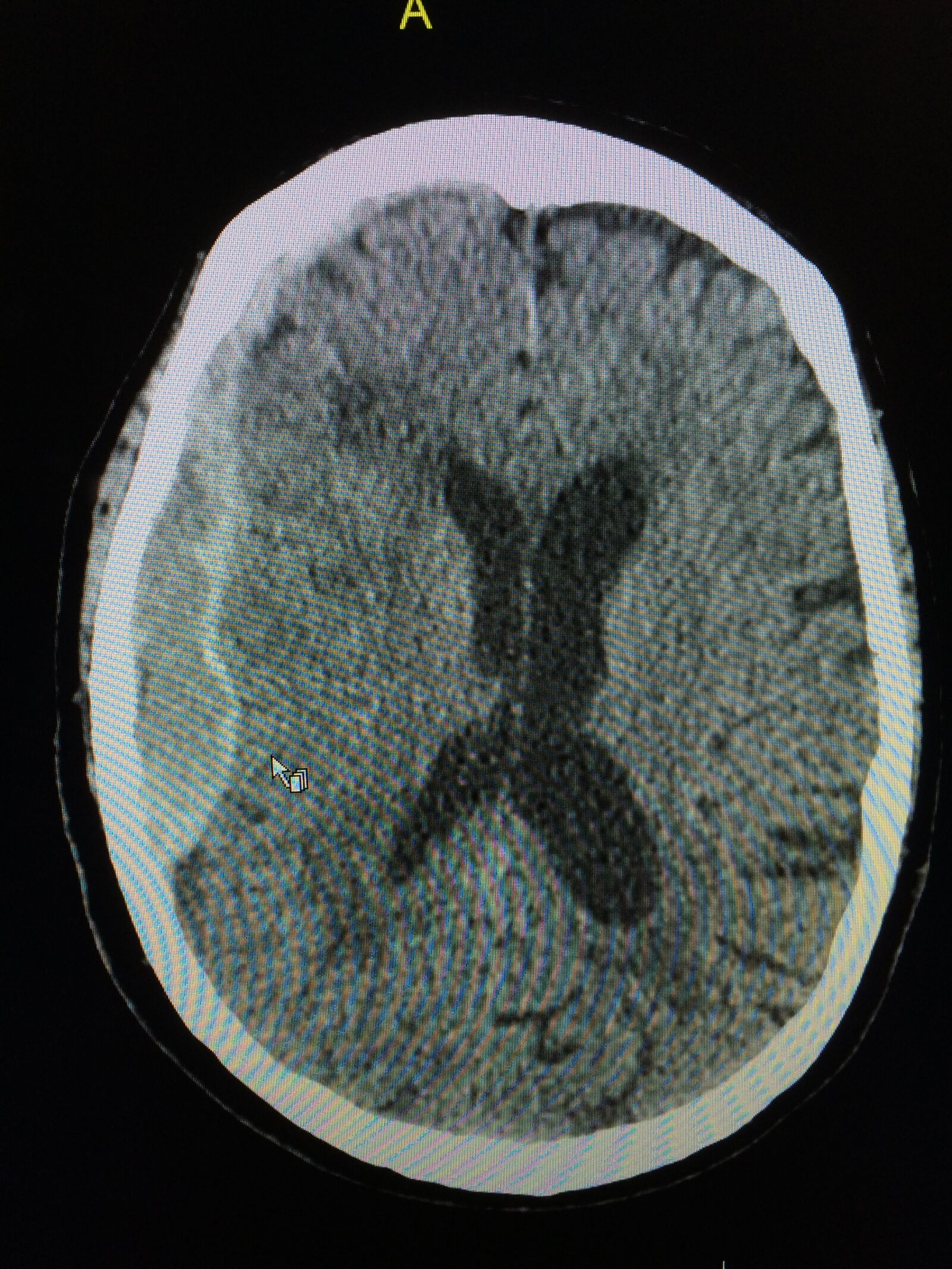 iPhone 5s back camera 4.15mm f/2.2 sample photo. Subdural, hematoma, blood photography