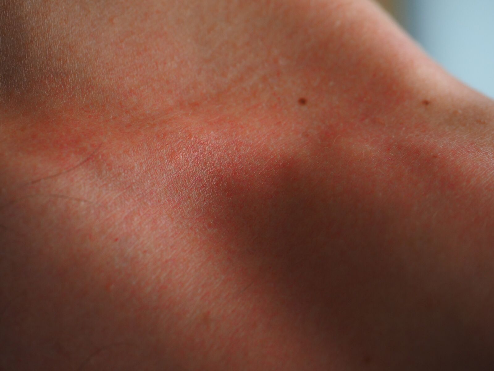 Olympus OM-D E-M1 + Olympus M.Zuiko Digital ED 12-40mm F2.8 Pro sample photo. Sunburn, skin, red photography