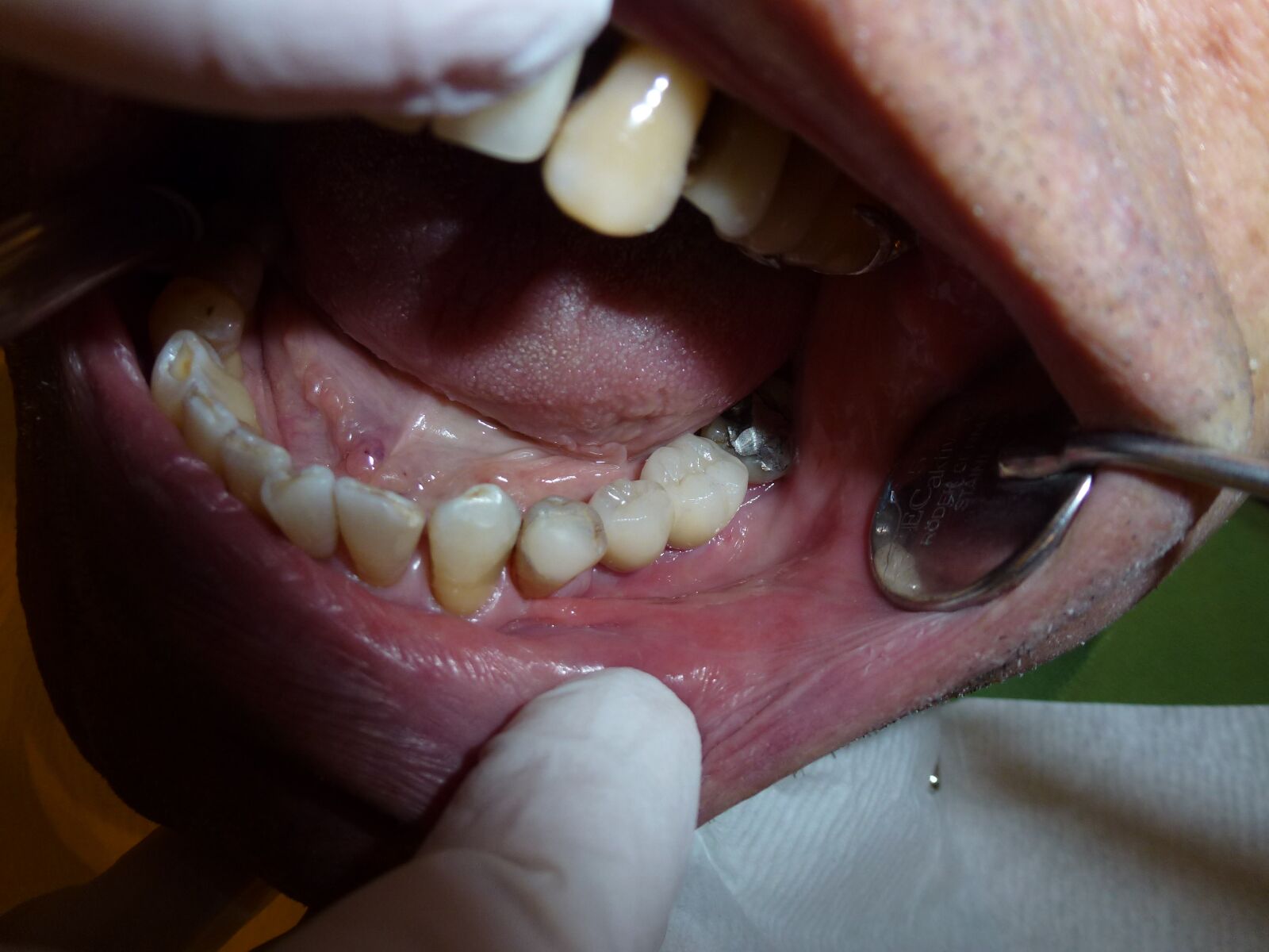 Panasonic DMC-ZS10 sample photo. Implant, dentistry, dentist photography
