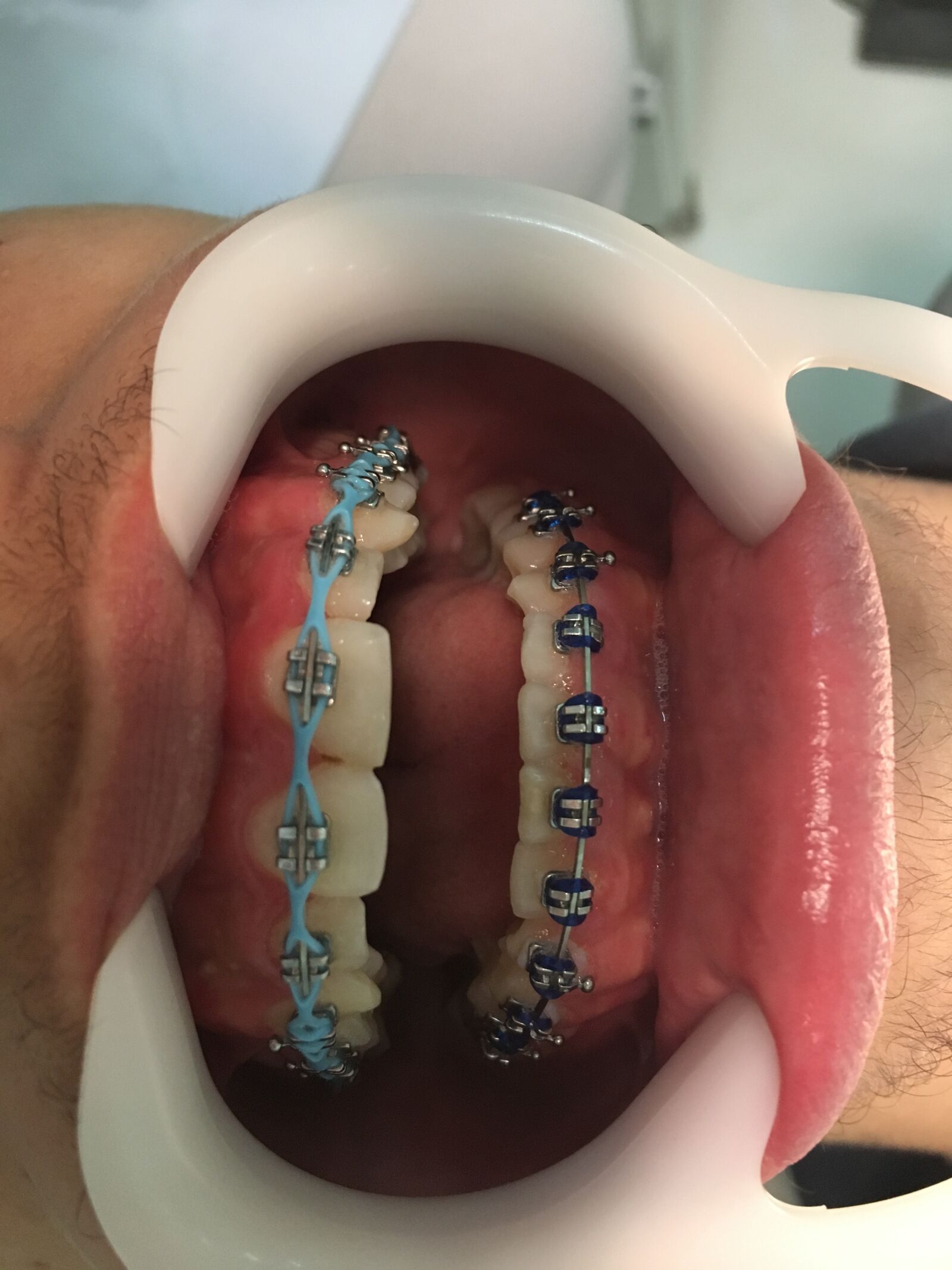 Apple iPhone 6s sample photo. Apparatus, tooth, smile photography