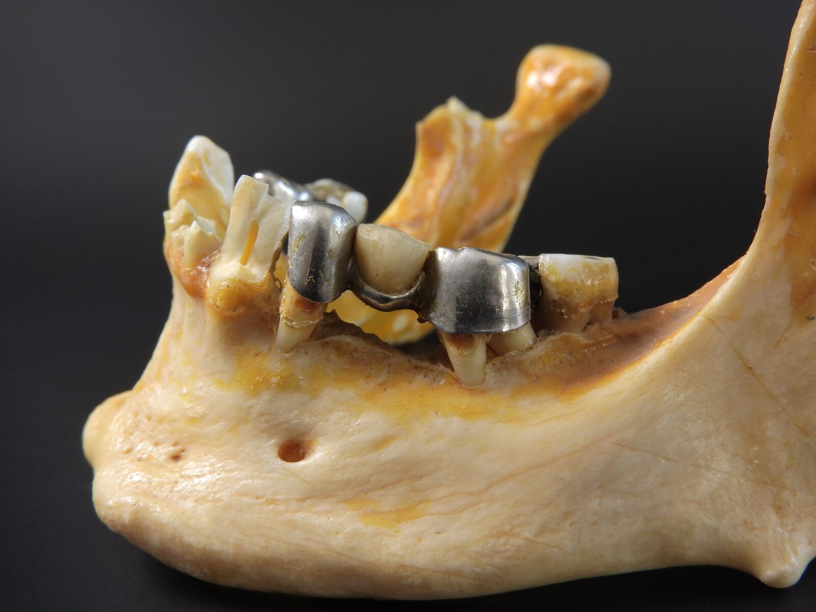 Nikon Coolpix P610 sample photo. A dental bridge, teeth photography