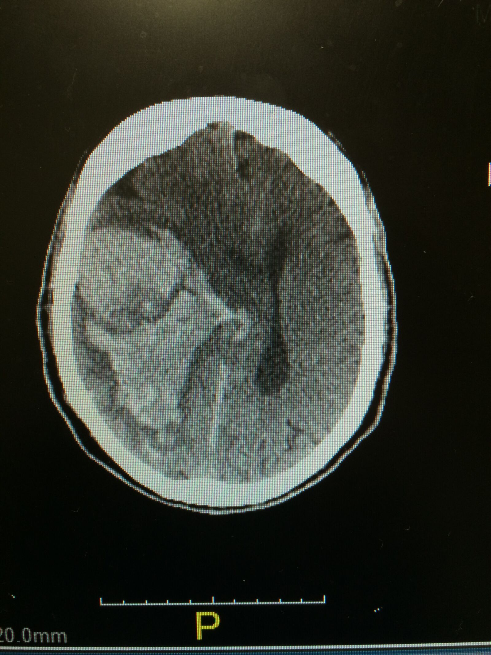 iPhone 5s back camera 4.15mm f/2.2 sample photo. Brain hemorrhage, stroke, brain photography