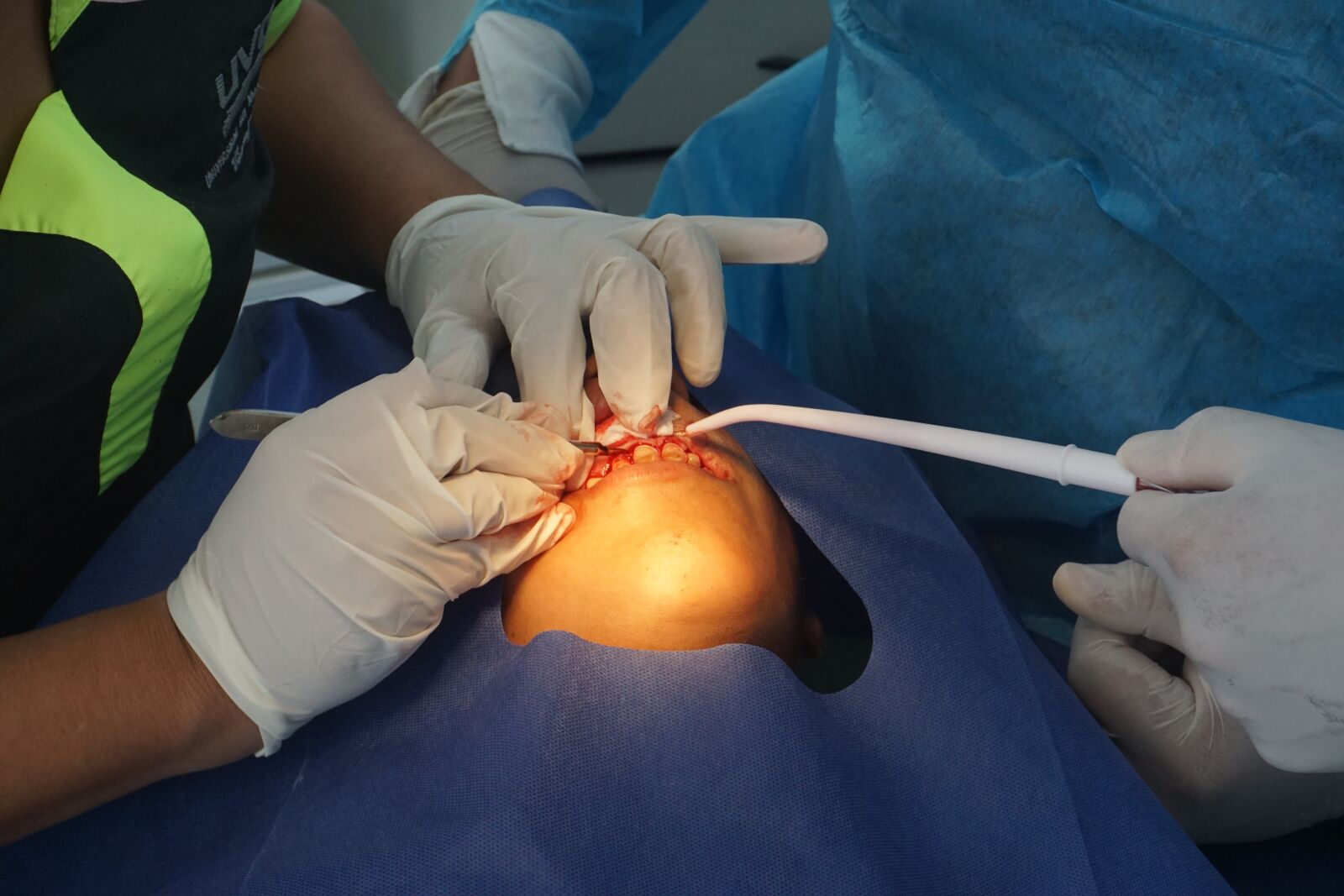 Sony a6000 sample photo. Cirugia dental, dental, diente photography