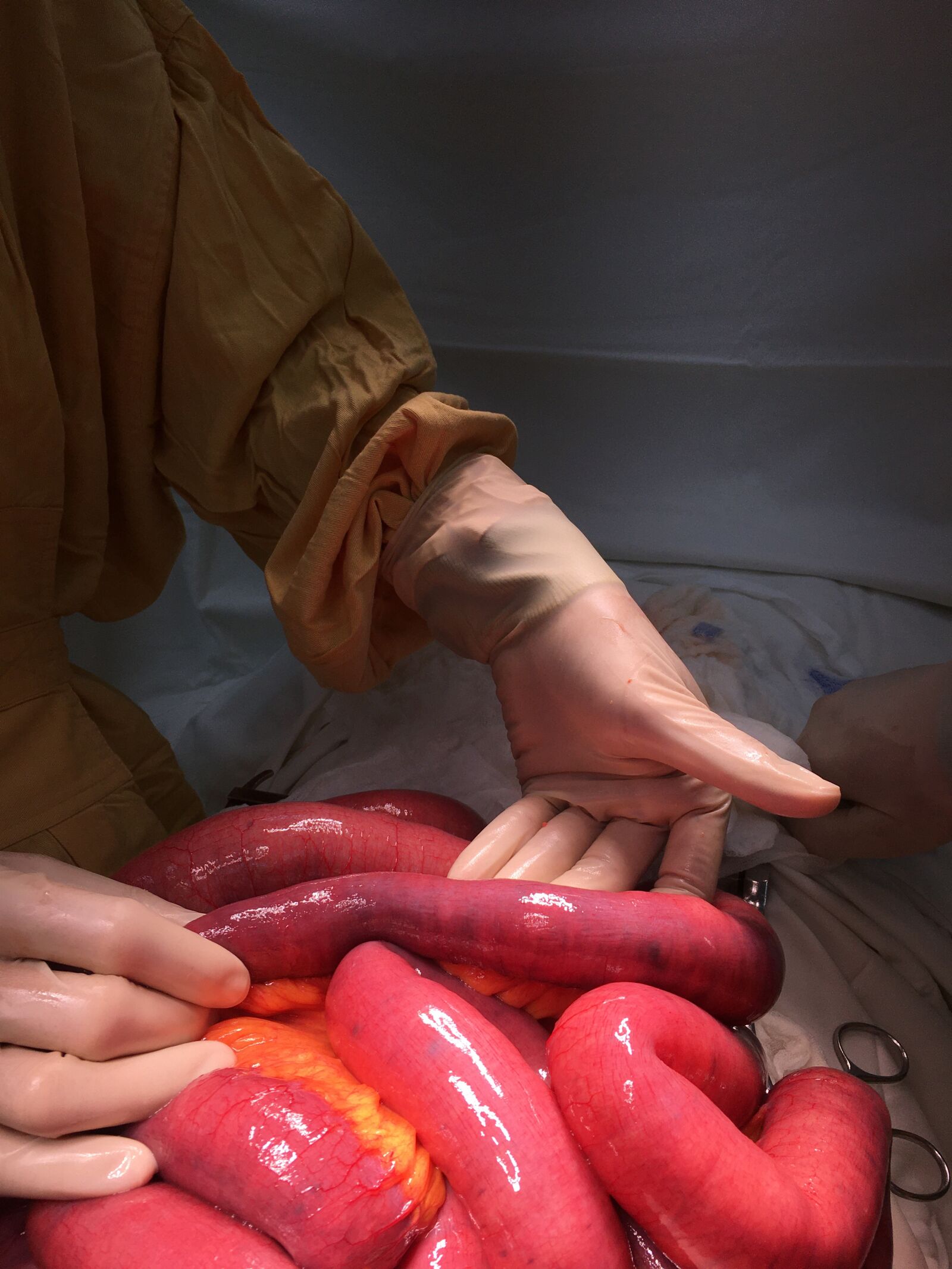 iPhone 6s back camera 4.15mm f/2.2 sample photo. Surgery, intestine, bs linh photography