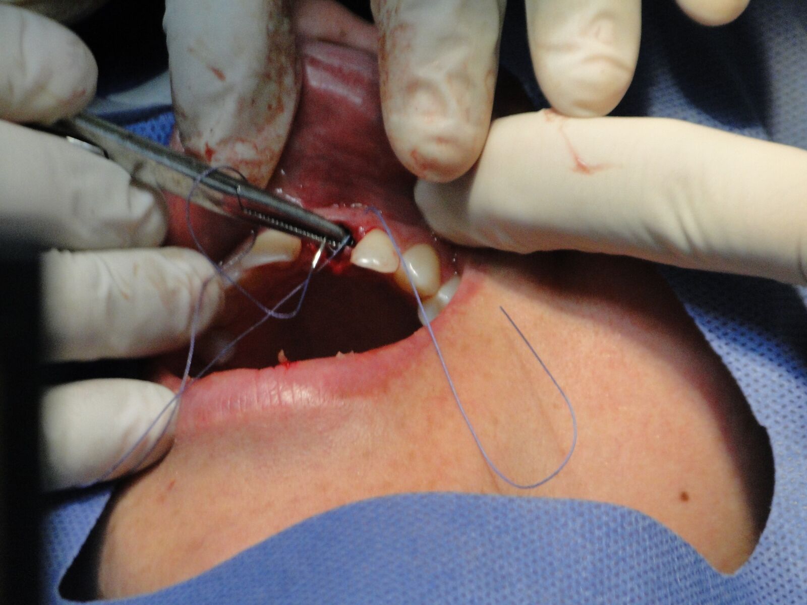 Sony Cyber-shot DSC-HX1 sample photo. Surgery, teeth, operation photography