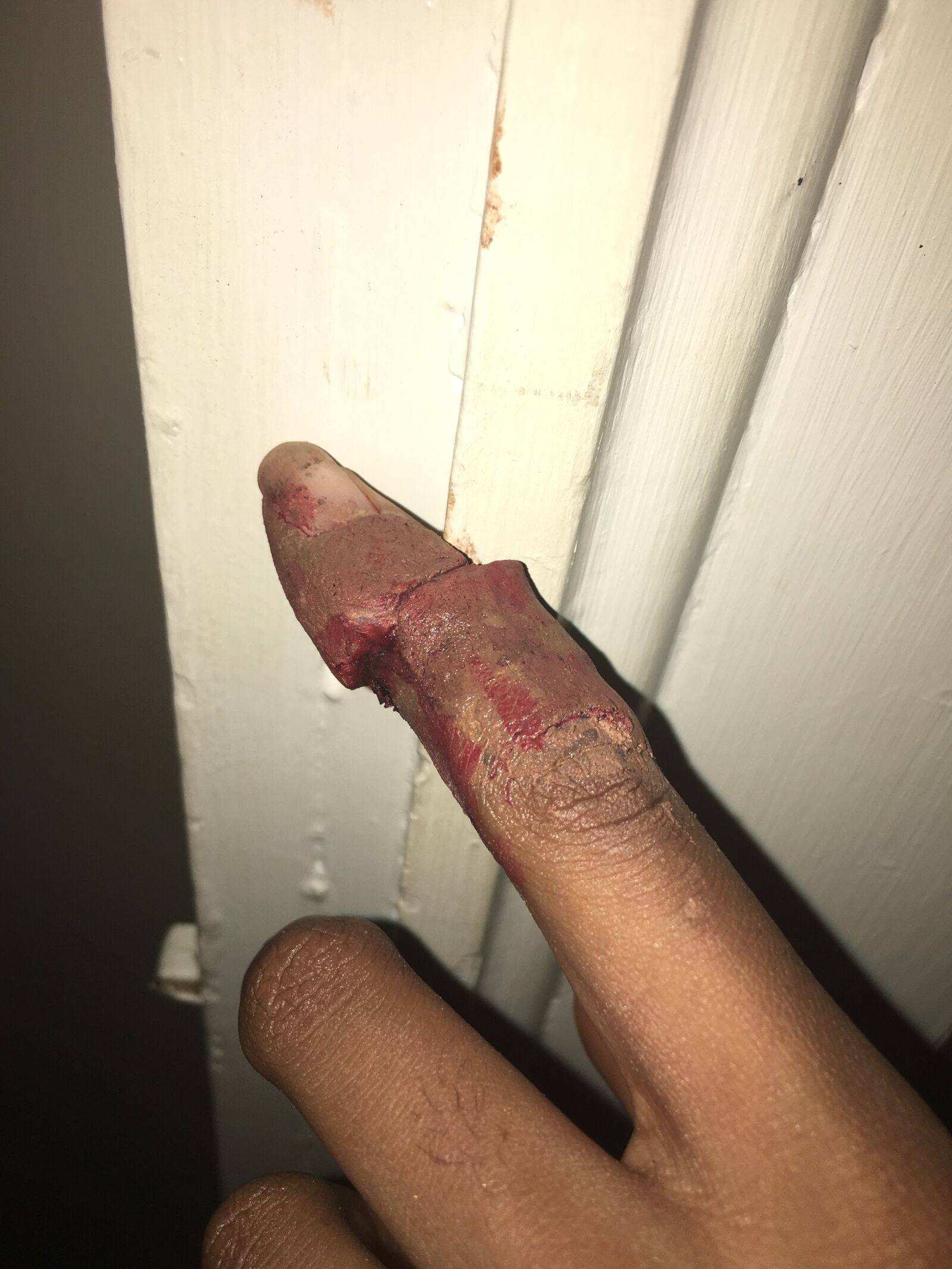 Apple iPhone 6s sample photo. Finger, injury, broken photography