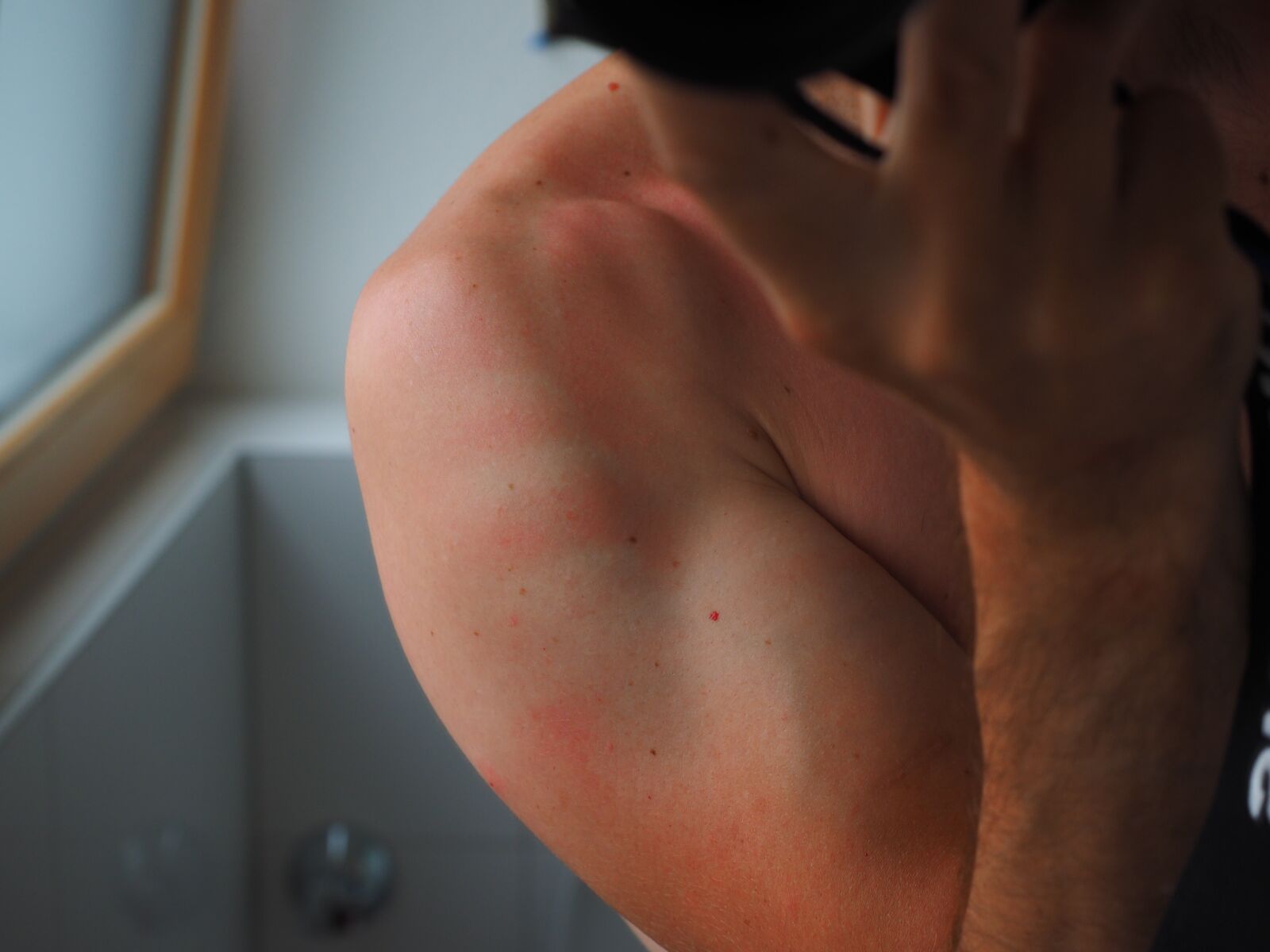 Olympus OM-D E-M1 + Olympus M.Zuiko Digital ED 12-40mm F2.8 Pro sample photo. Sunburn, skin, red photography