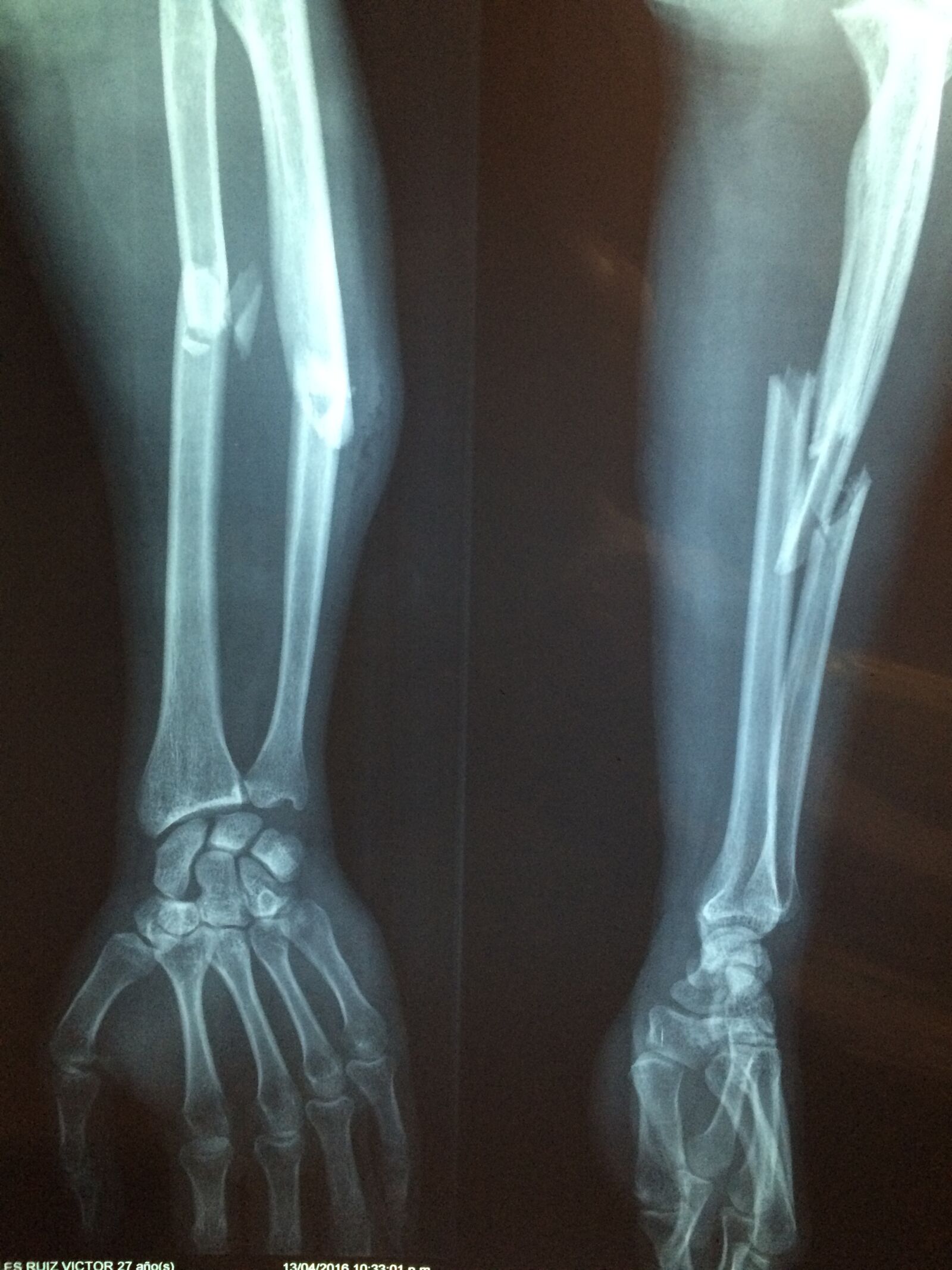 iPhone 5s back camera 4.15mm f/2.2 sample photo. Fracture bone, xray, skeleton photography