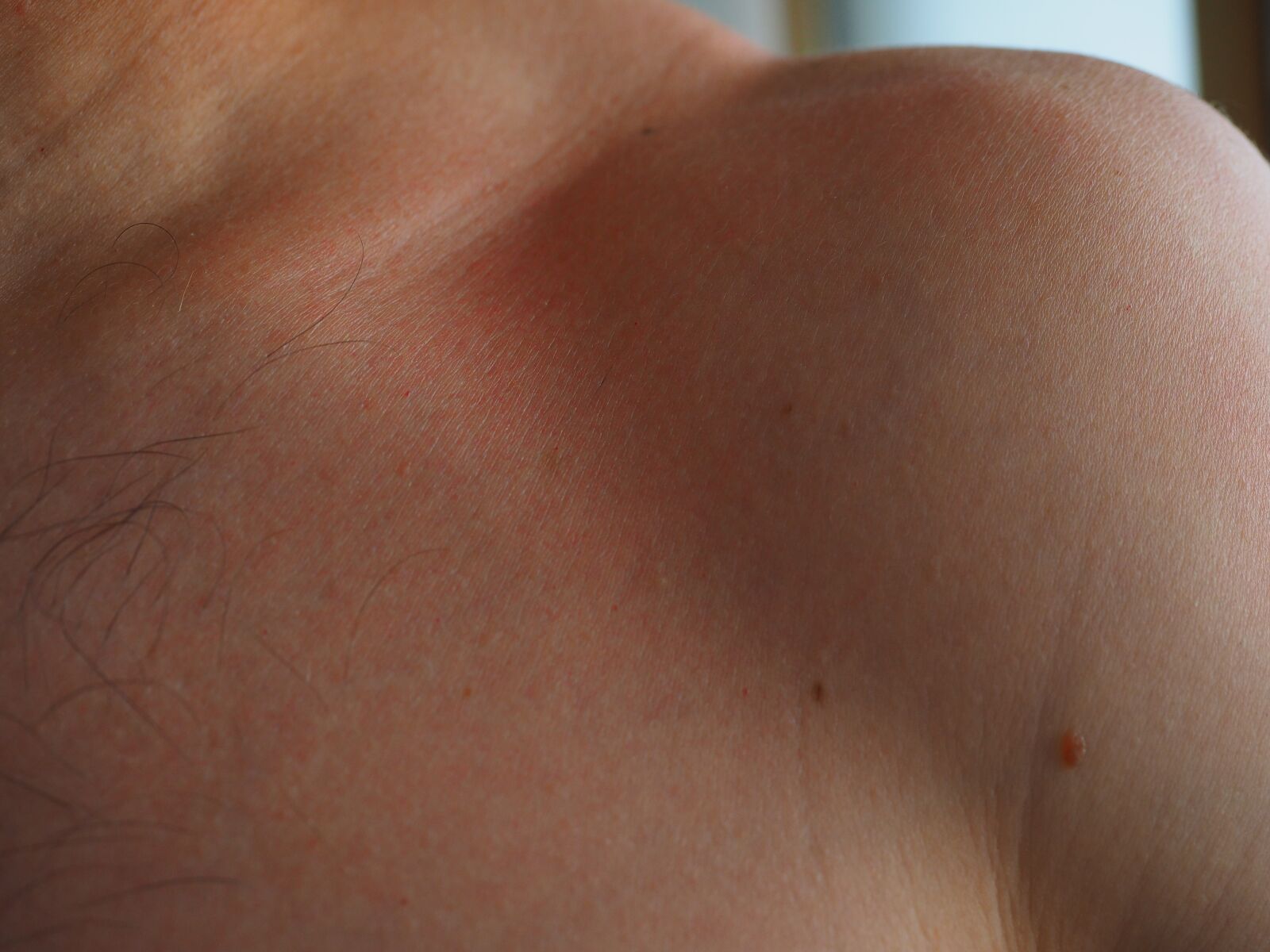 Olympus OM-D E-M1 + Olympus M.Zuiko Digital ED 12-40mm F2.8 Pro sample photo. Sunburn, skin, red photography
