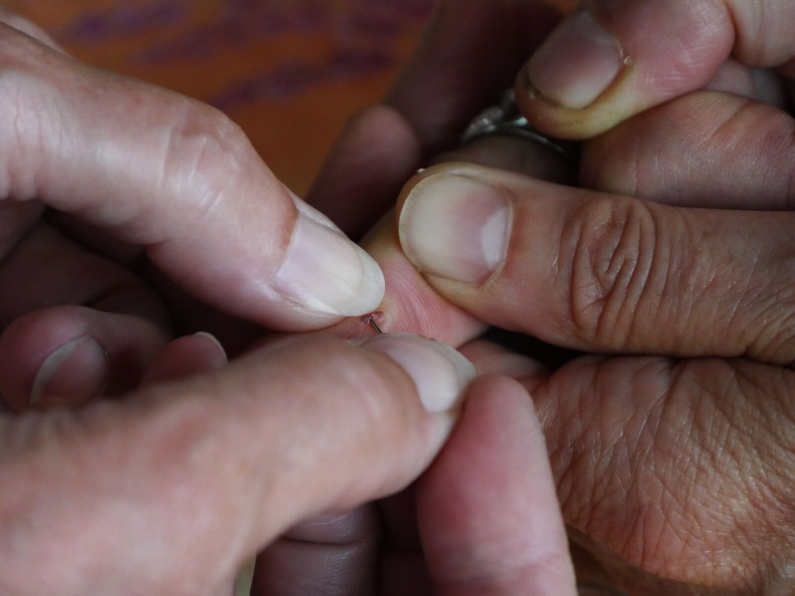 Panasonic Lumix DMC-GX8 sample photo. Wound, first aid, splitter photography