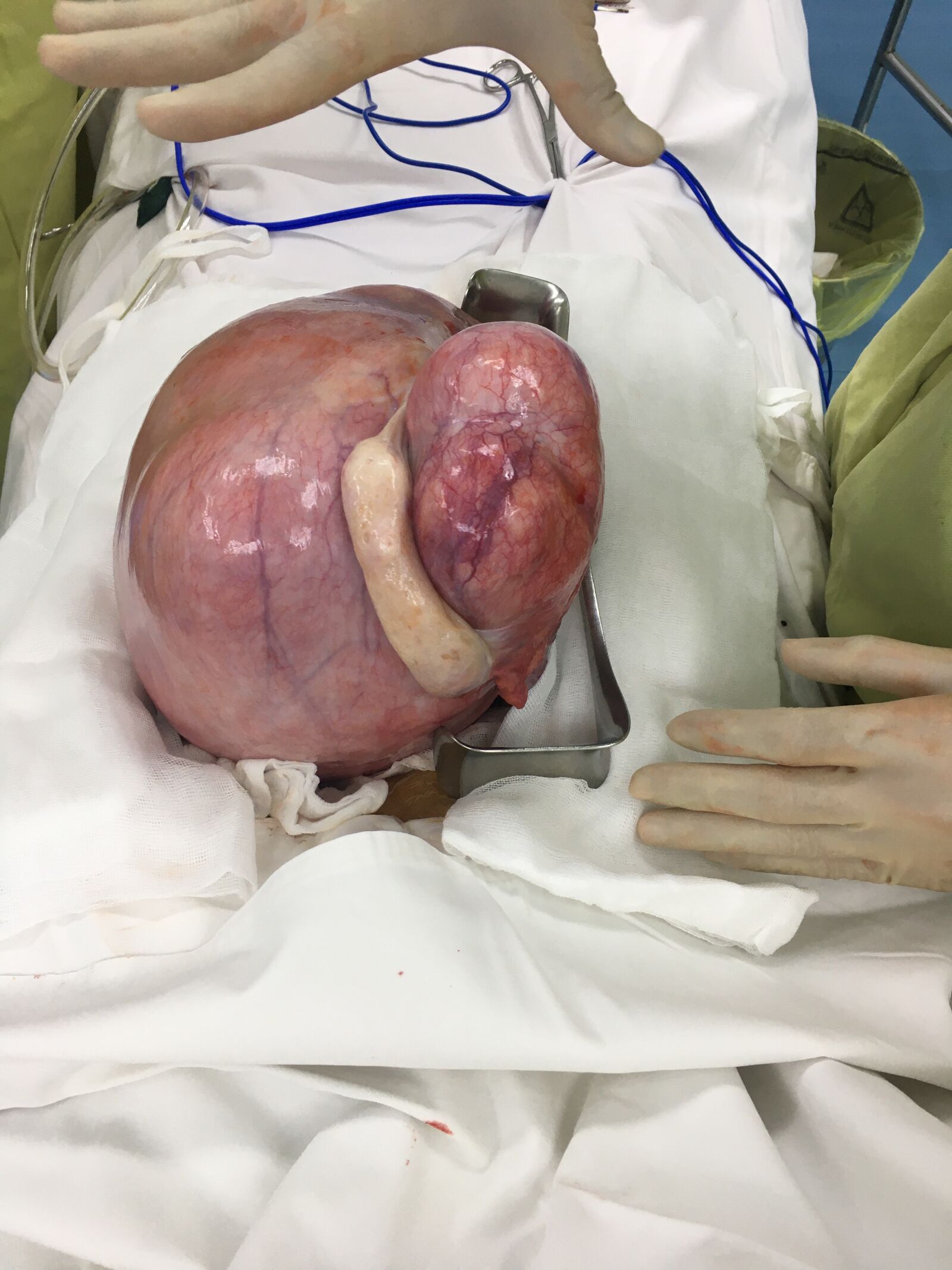 iPhone 6s back camera 4.15mm f/2.2 sample photo. Surgery, uterine tumors, bs photography