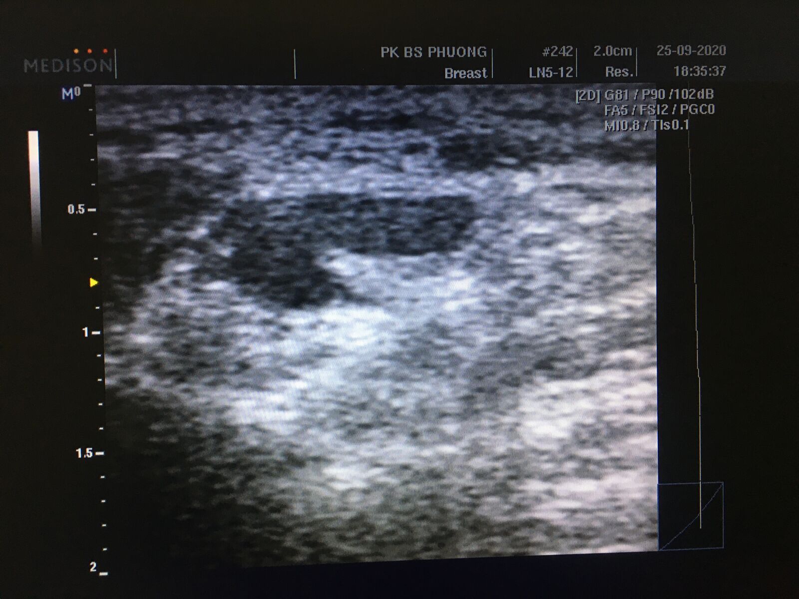 iPhone 6s back camera 4.15mm f/2.2 sample photo. Cervical lymph node, inflammation photography