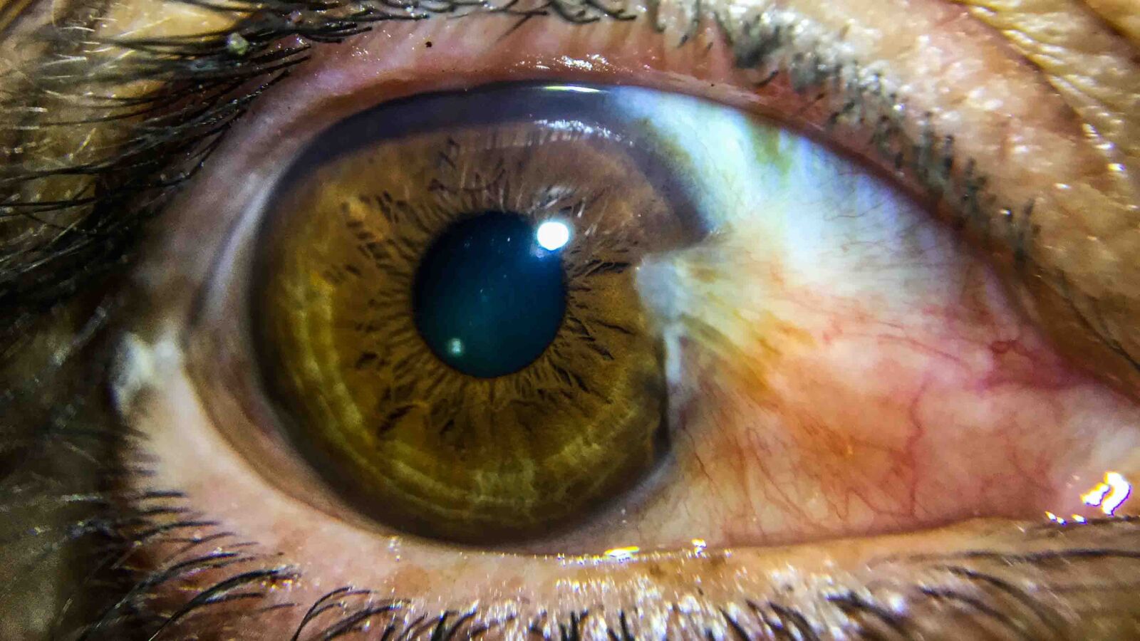 Apple iPod touch sample photo. Eye, pterygium, red eye photography