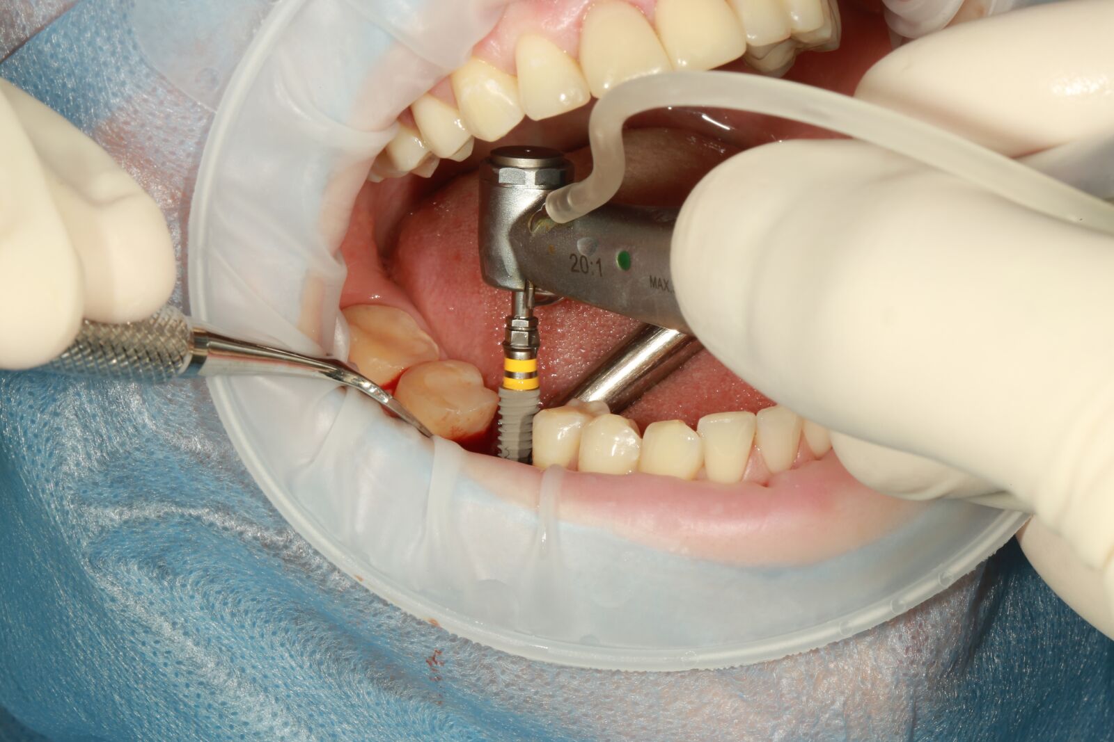 Canon EF 100mm F2.8L Macro IS USM sample photo. Dental, implant, surgery photography