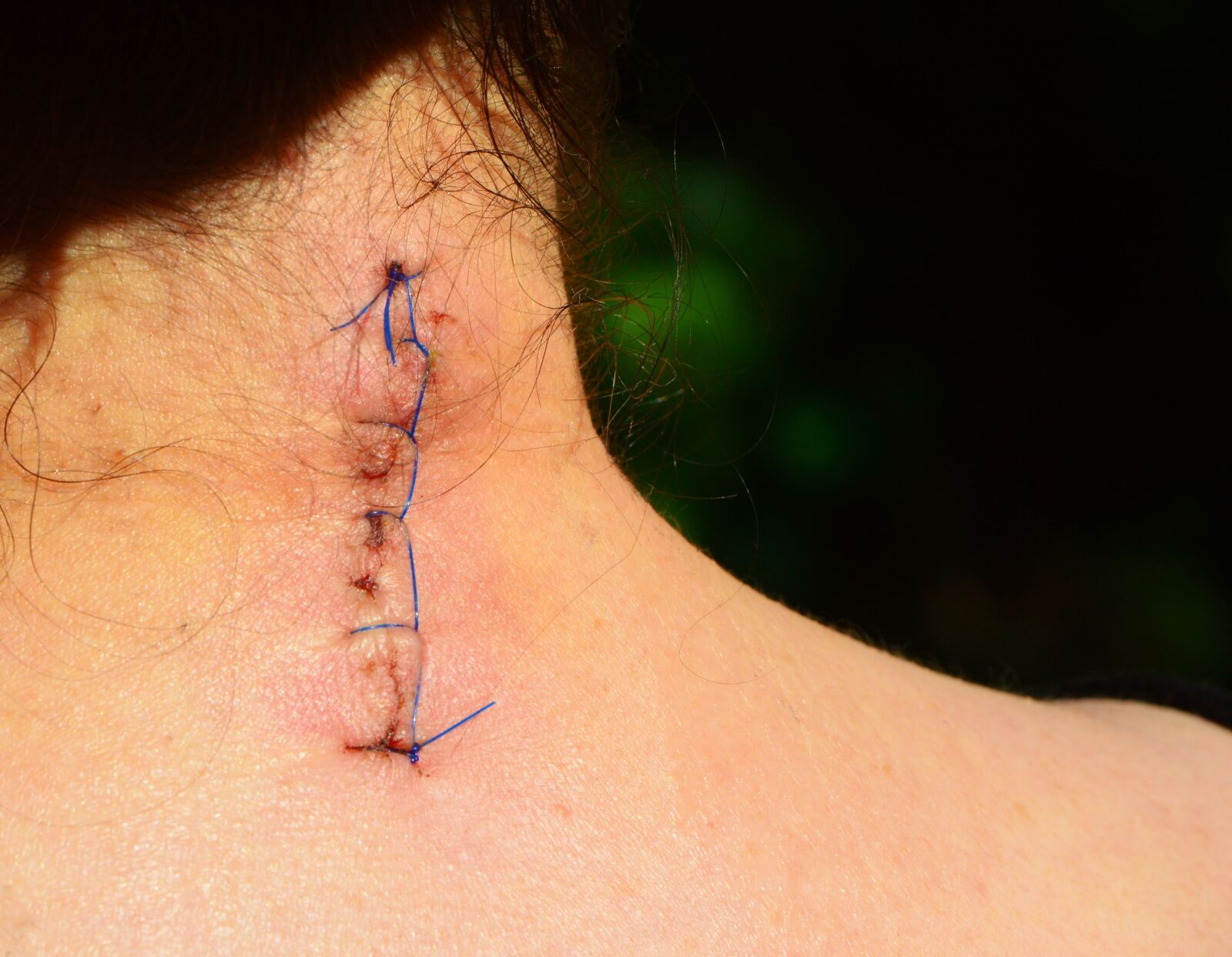 Nikon D3200 sample photo. Discogenic operational, wound, seam photography