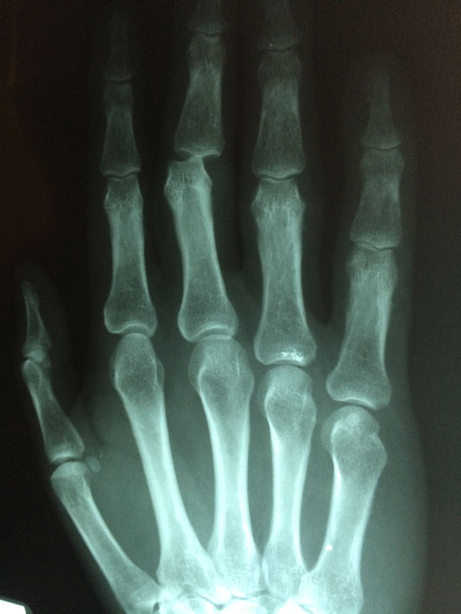 iPhone 5s back camera 4.15mm f/2.2 sample photo. Hand, fracture, broken photography