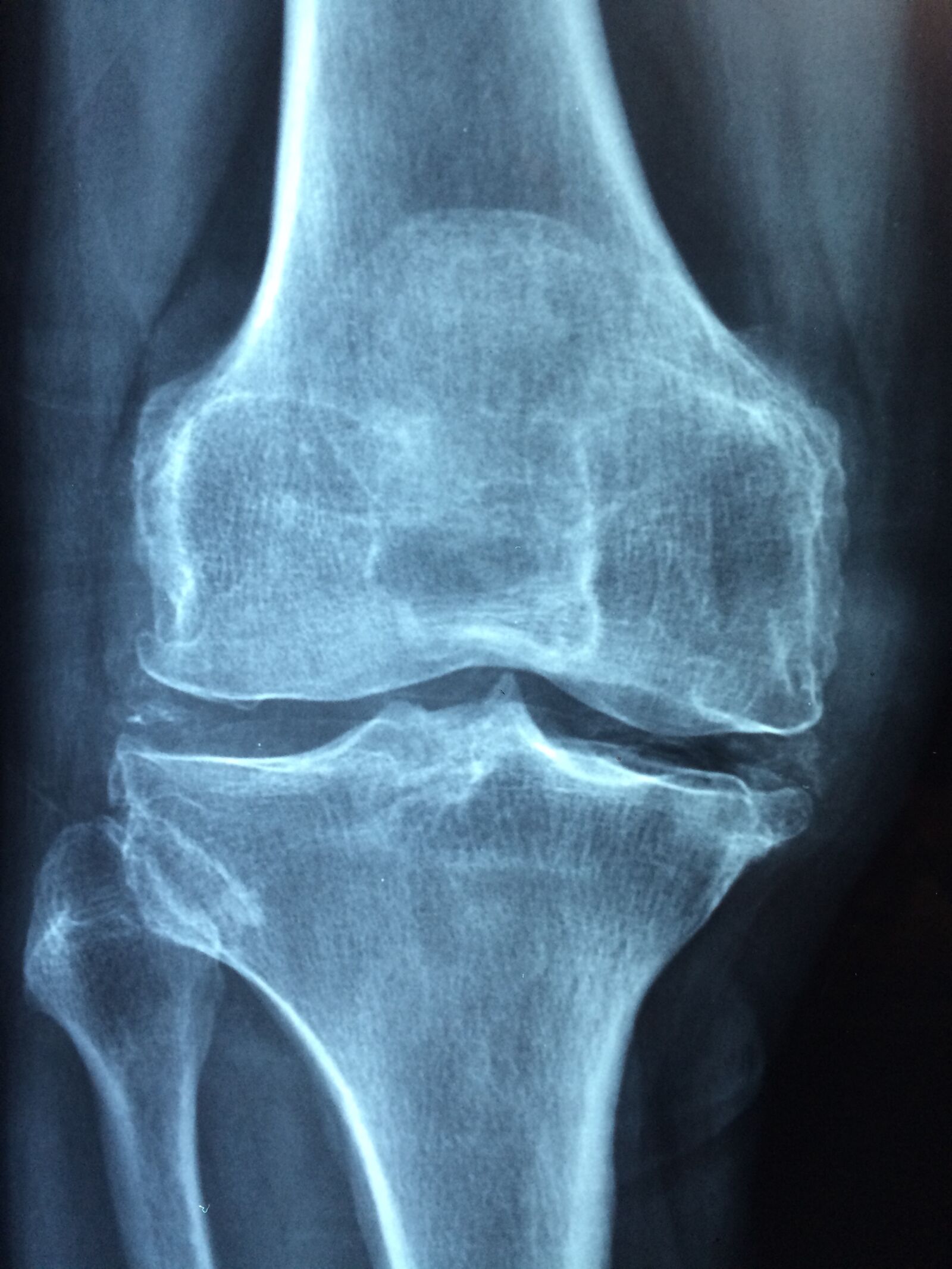 Apple iPhone 5s sample photo. Knee, old, care photography