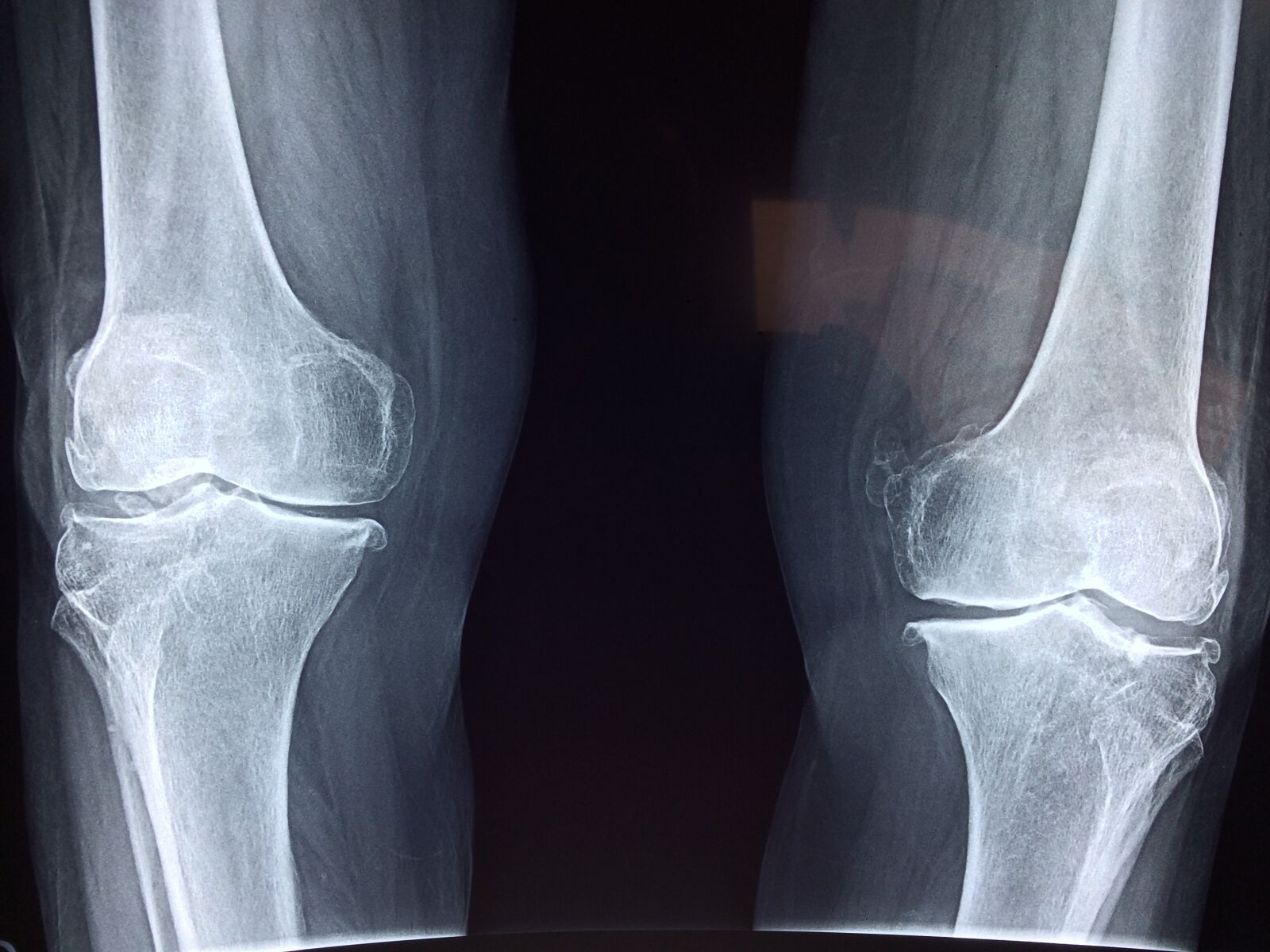 iPhone 5s back camera 4.15mm f/2.2 sample photo. Knee, x-ray, medical photography