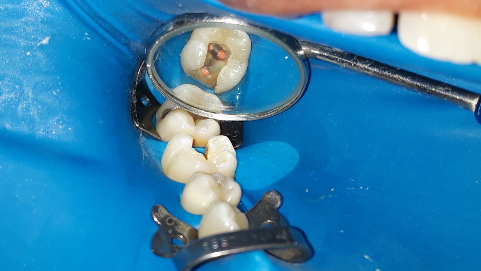 Samsung Galaxy J5 Pro sample photo. Dentista, dente, isolamento photography