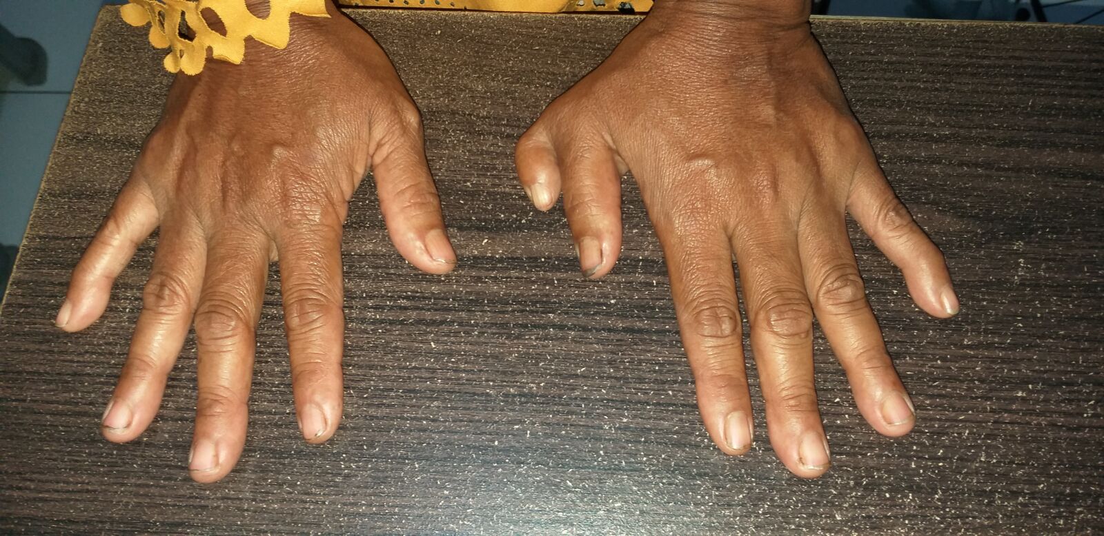 Samsung Galaxy A6+ sample photo. Human, polydactyly, patient photography