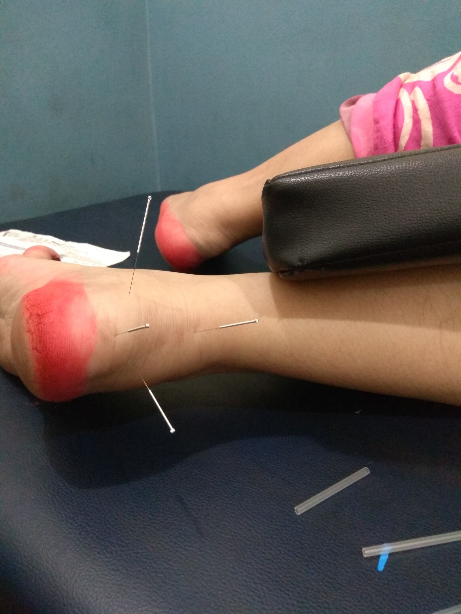 Xiaomi Redmi Note 4 sample photo. Accupuncture, pain, physio photography