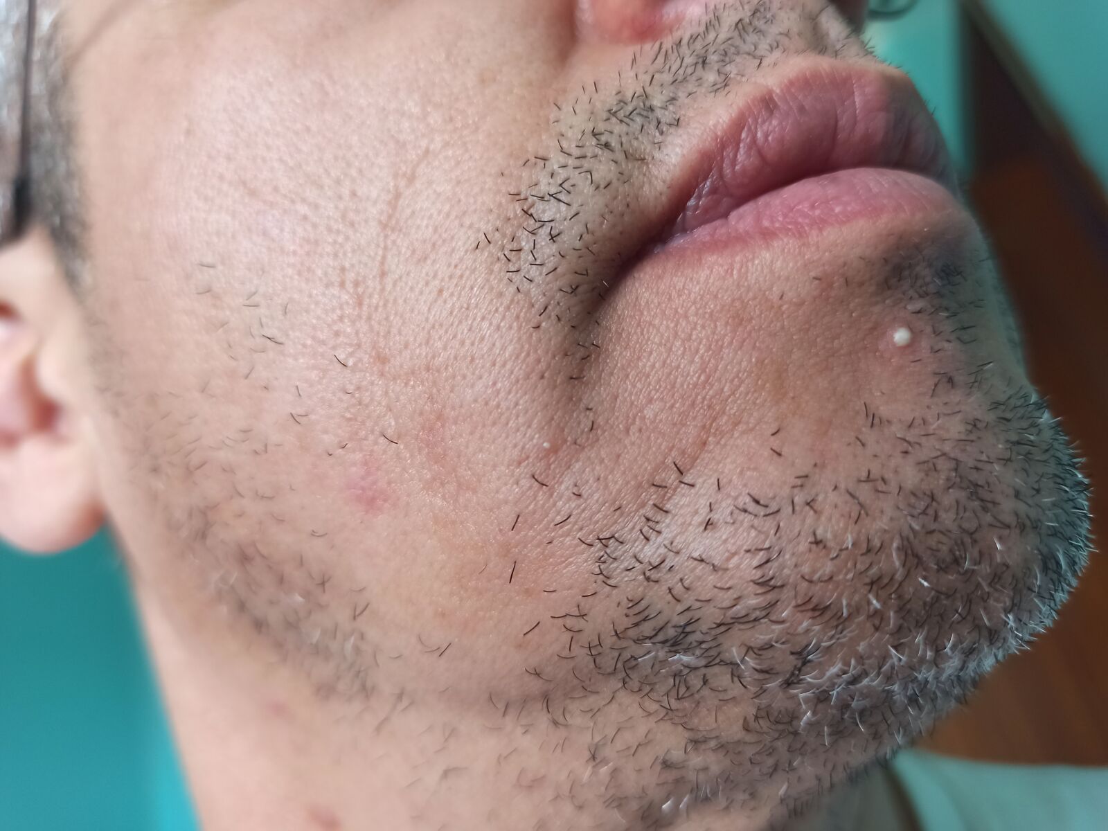 Xiaomi Redmi Note 8 Pro sample photo. Acne, face, skin photography