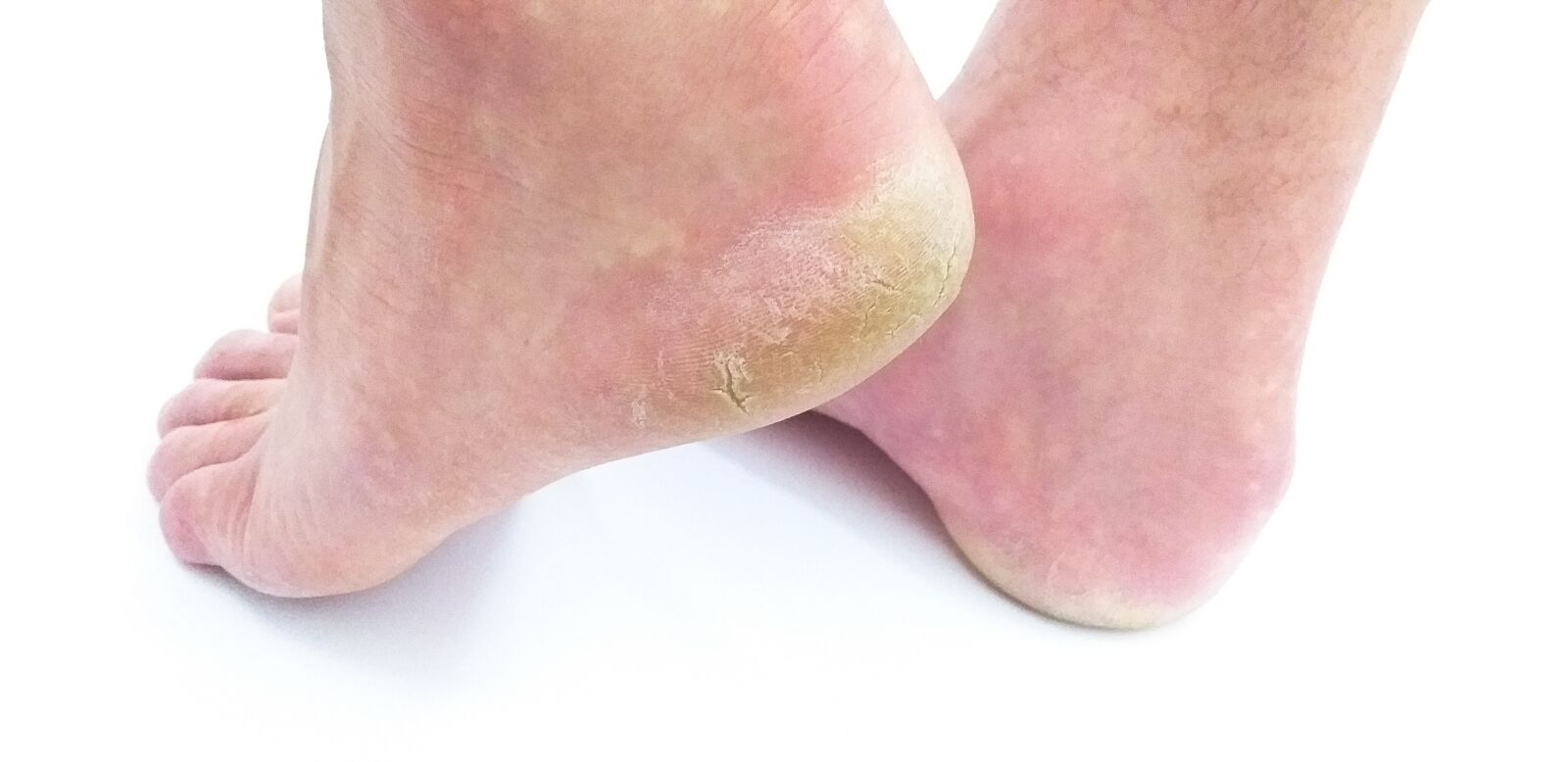 Samsung Galaxy J6+ sample photo. Cornea, skin, foot photography