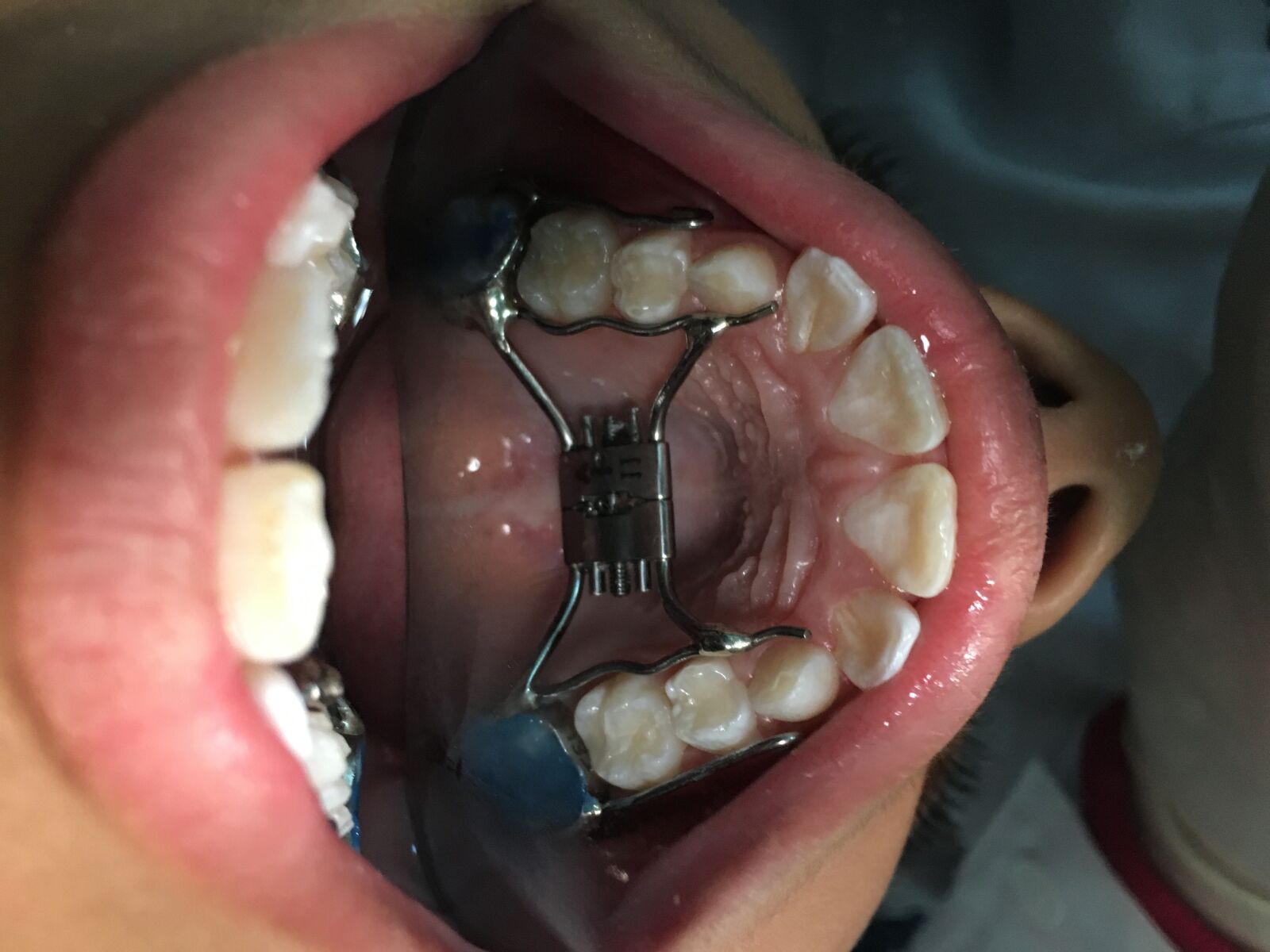 Apple iPhone 6s sample photo. Apparatus, the sunrise, tooth photography