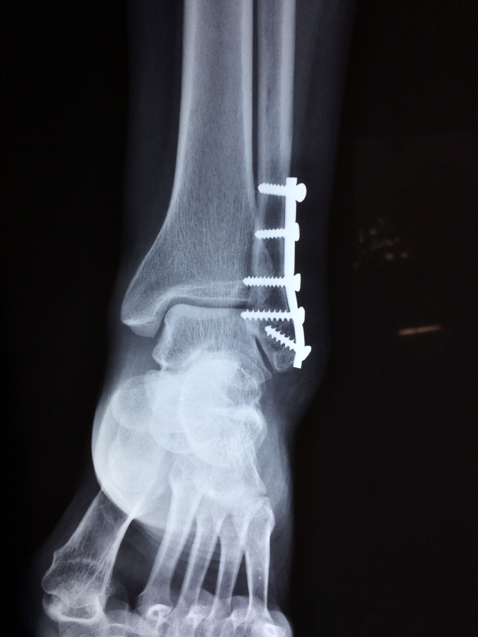 iPhone 5s back camera 4.15mm f/2.2 sample photo. Ankle, fracture, foot photography