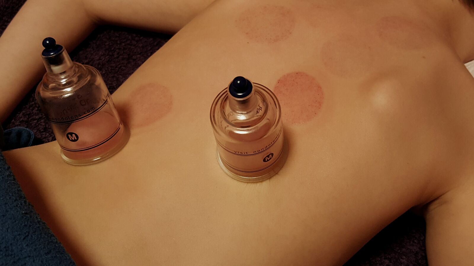 Samsung Galaxy S6 sample photo. Cupping, health, detoxify photography