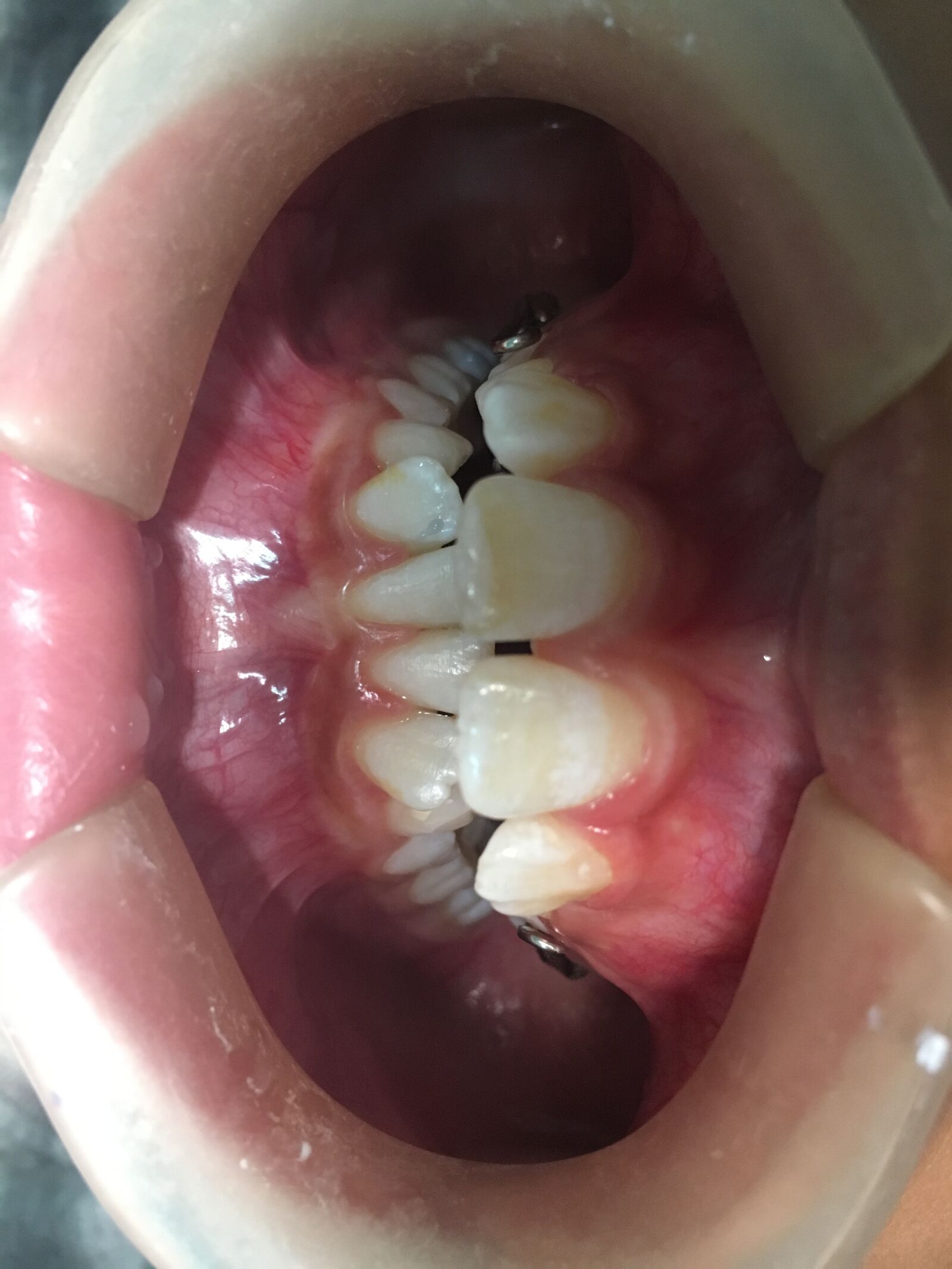iPhone 6s back camera 4.15mm f/2.2 sample photo. Tooth, bite, smile photography