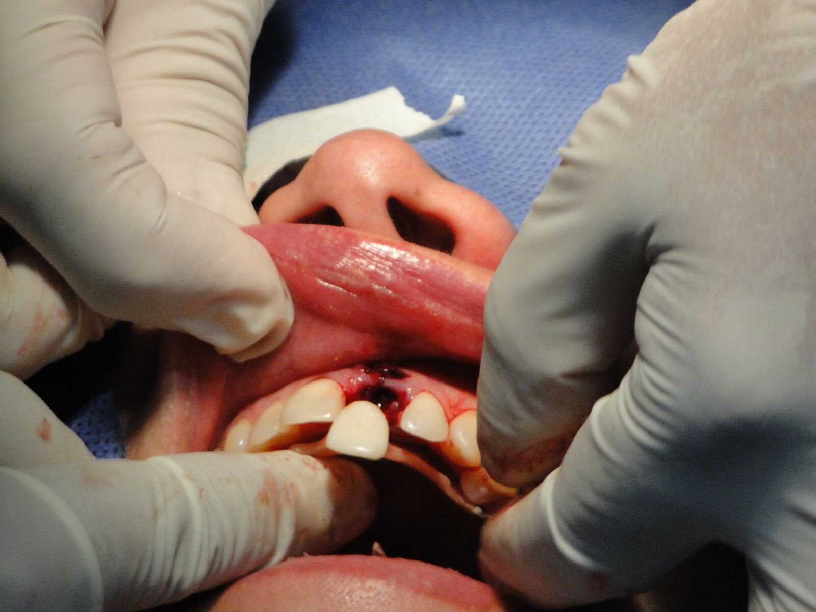 Sony Cyber-shot DSC-HX1 sample photo. Surgery, teeth, operation photography