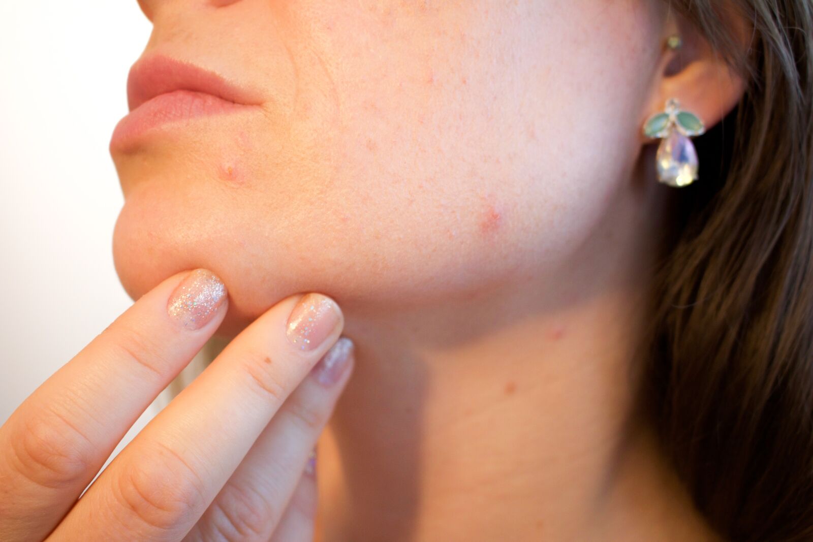 Canon EOS 700D (EOS Rebel T5i / EOS Kiss X7i) sample photo. Acne, pores, skin photography