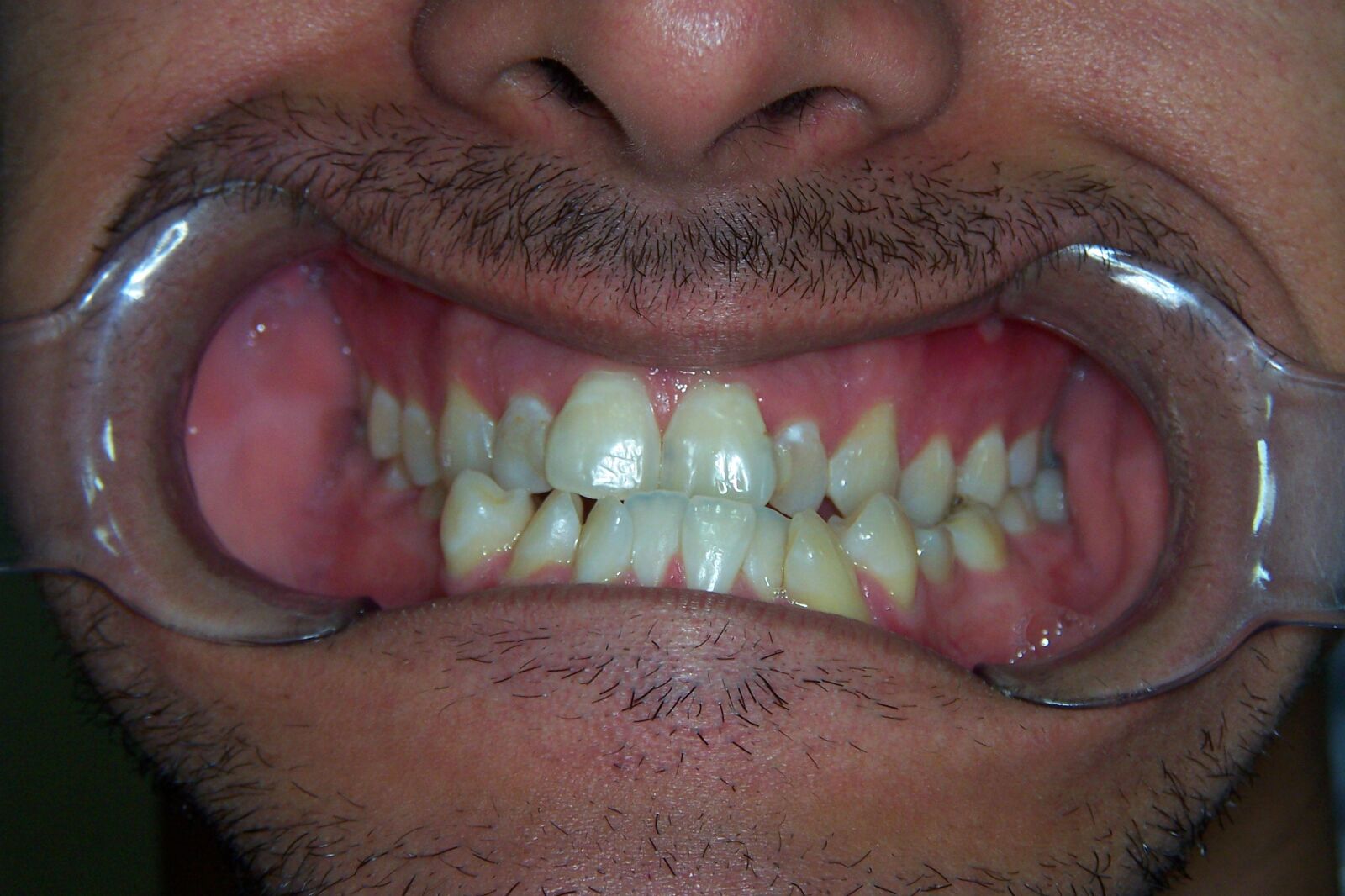 Kodak DX7590 ZOOM DIGITAL CAMERA sample photo. Crooked, teeth, crooked teeth photography