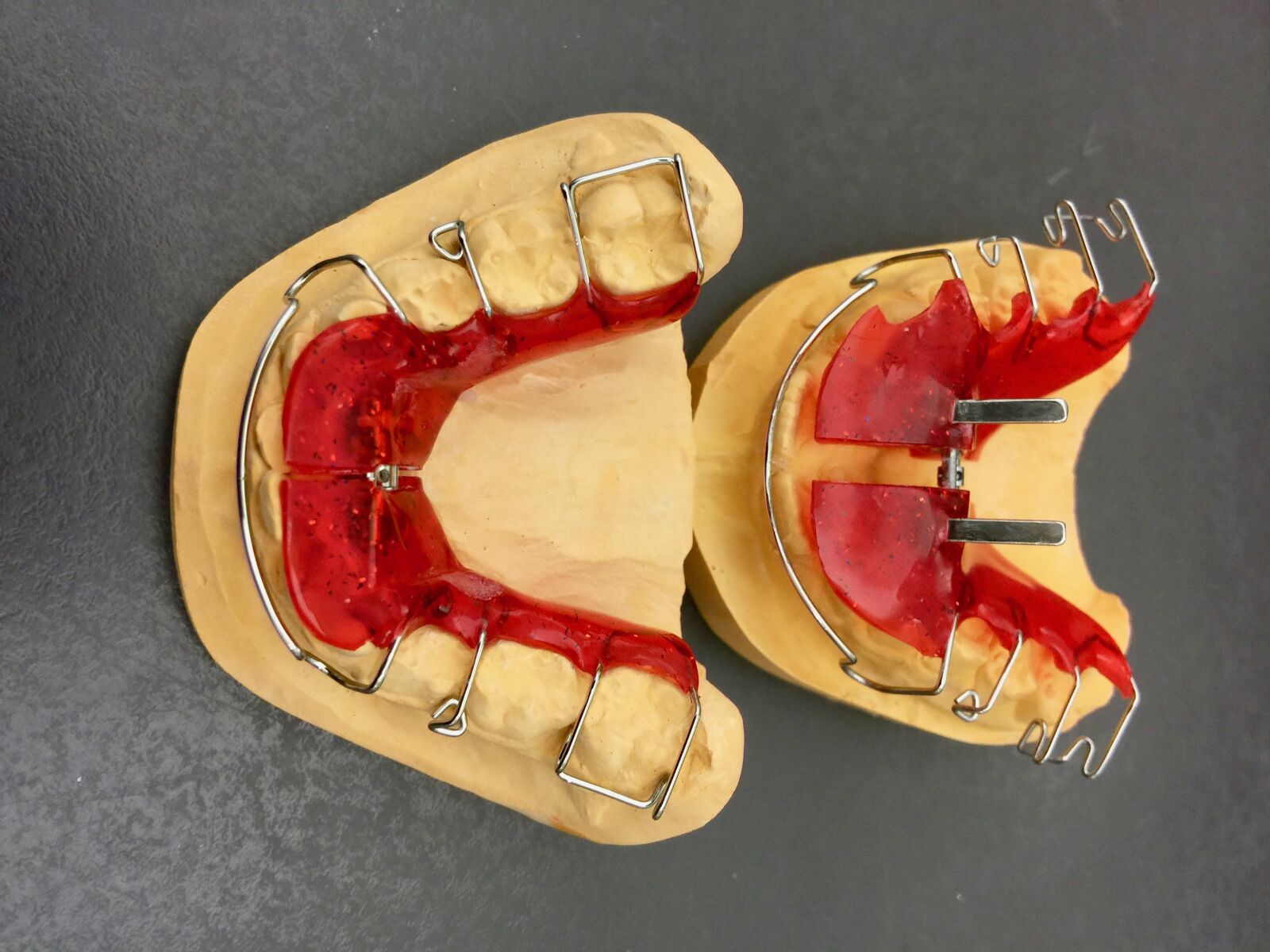 iPhone 6 Plus back camera 4.15mm f/2.2 sample photo. Orthodontics, dental braces, plaster photography