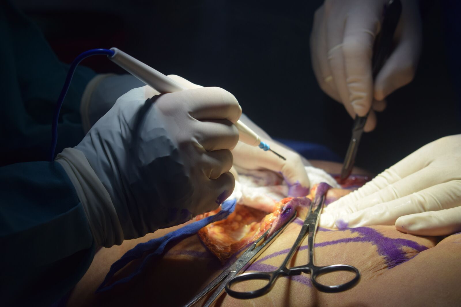 Nikon D3300 sample photo. Plastic surgery, medical, operating photography