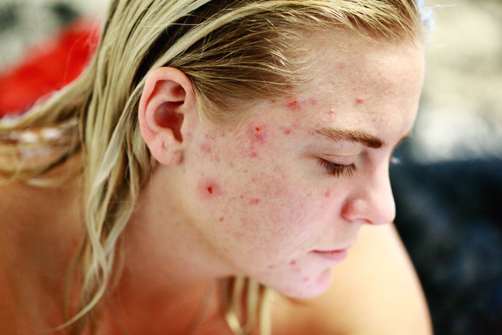 Canon EOS 5D Mark II sample photo. Struggle, acne, self love photography