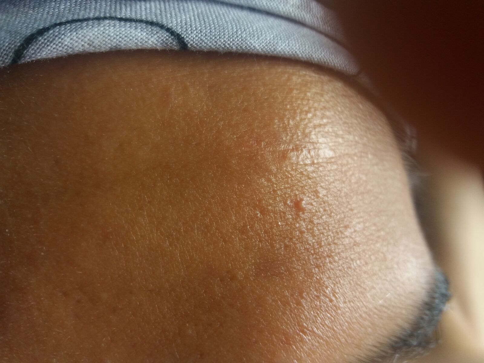 Samsung Galaxy J5 sample photo. Acne, skin, dermatology photography