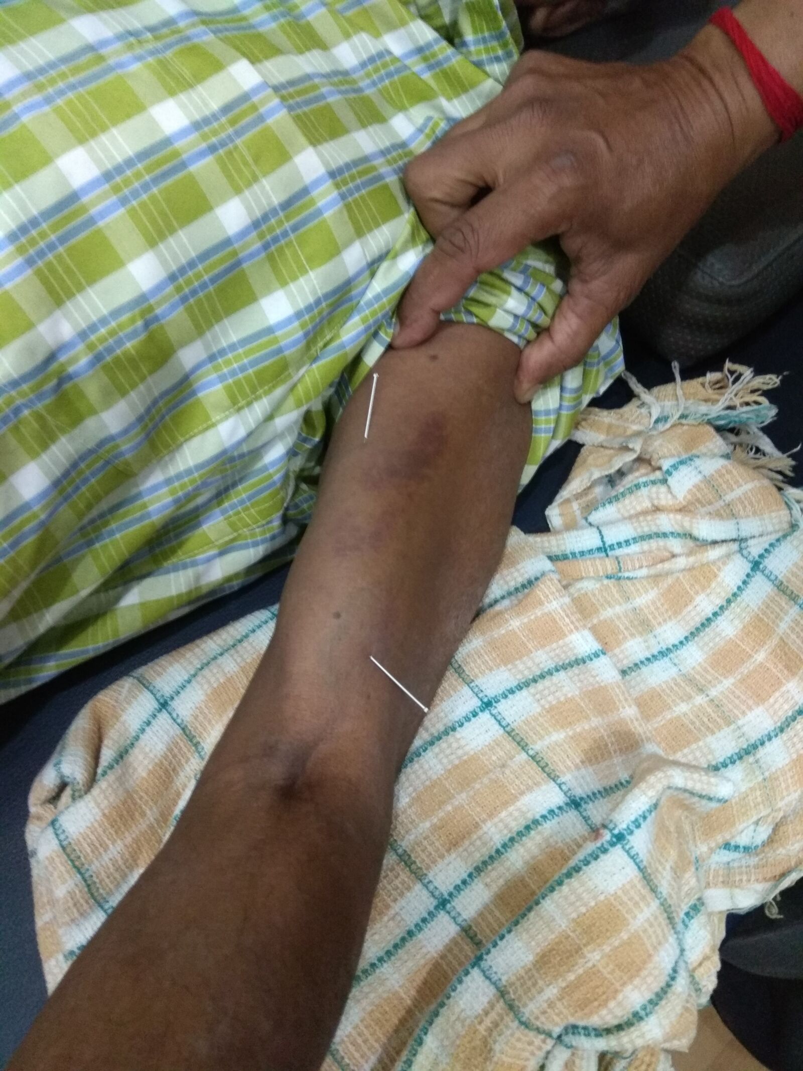 Xiaomi Redmi Note 4 sample photo. Dryneedling, physio, pain photography