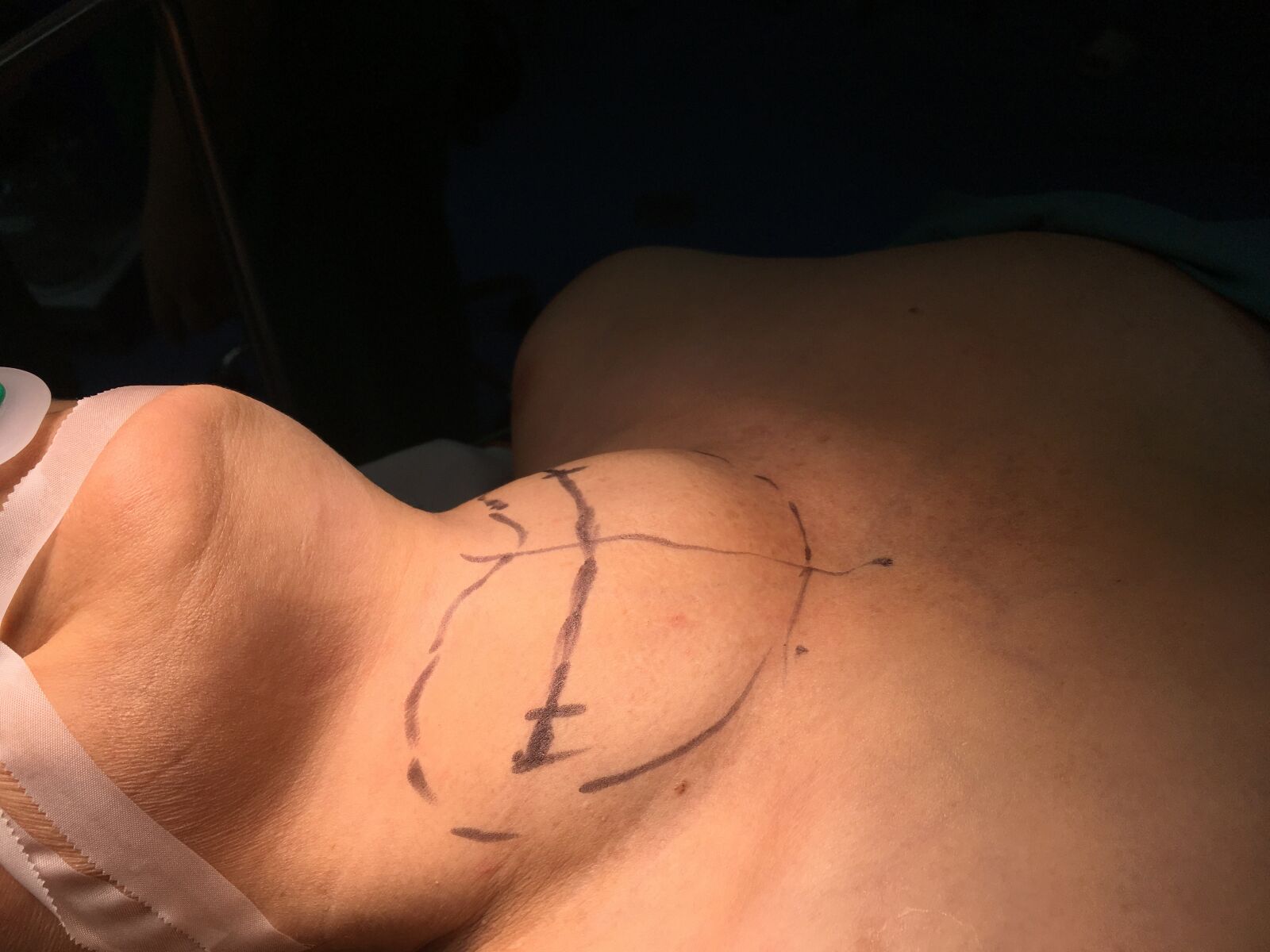 iPhone 6s back camera 4.15mm f/2.2 sample photo. Surgery, thyroid, bs linh photography