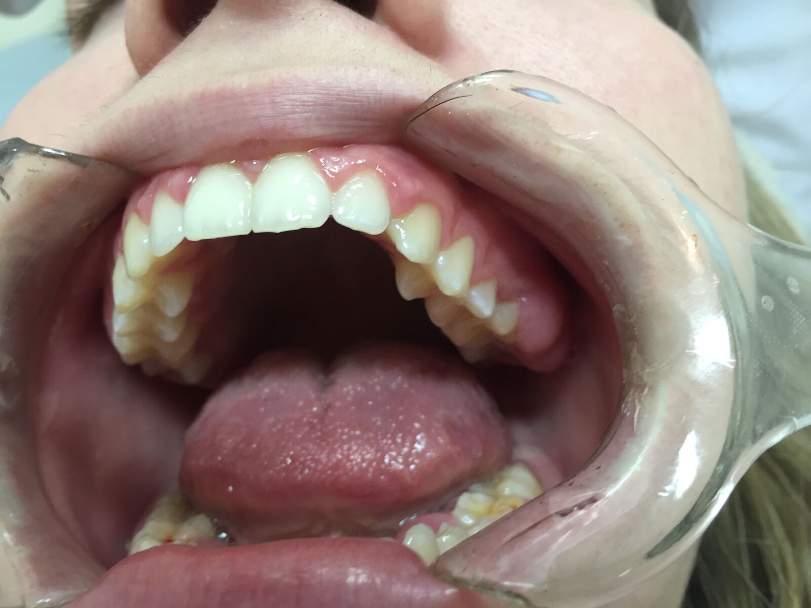 Apple iPhone 6 sample photo. Dentist, mouth, open mouth photography