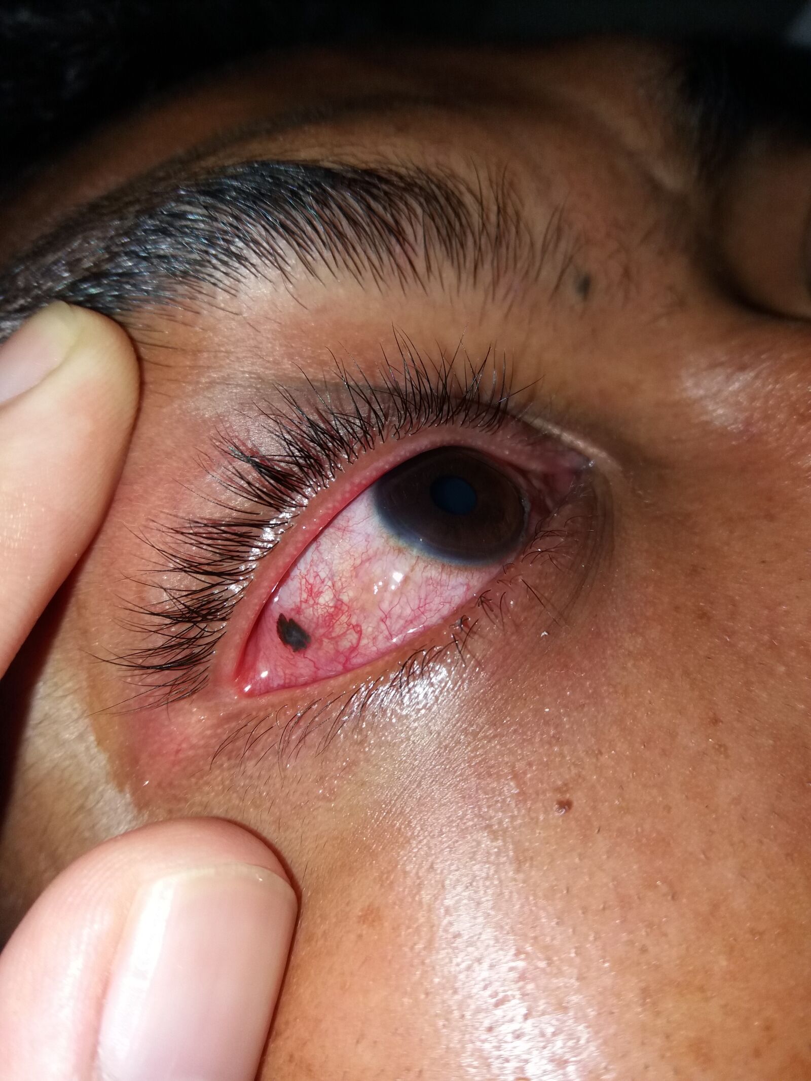 Samsung Galaxy J5(2016) sample photo. Eye, trauma, foreign body photography